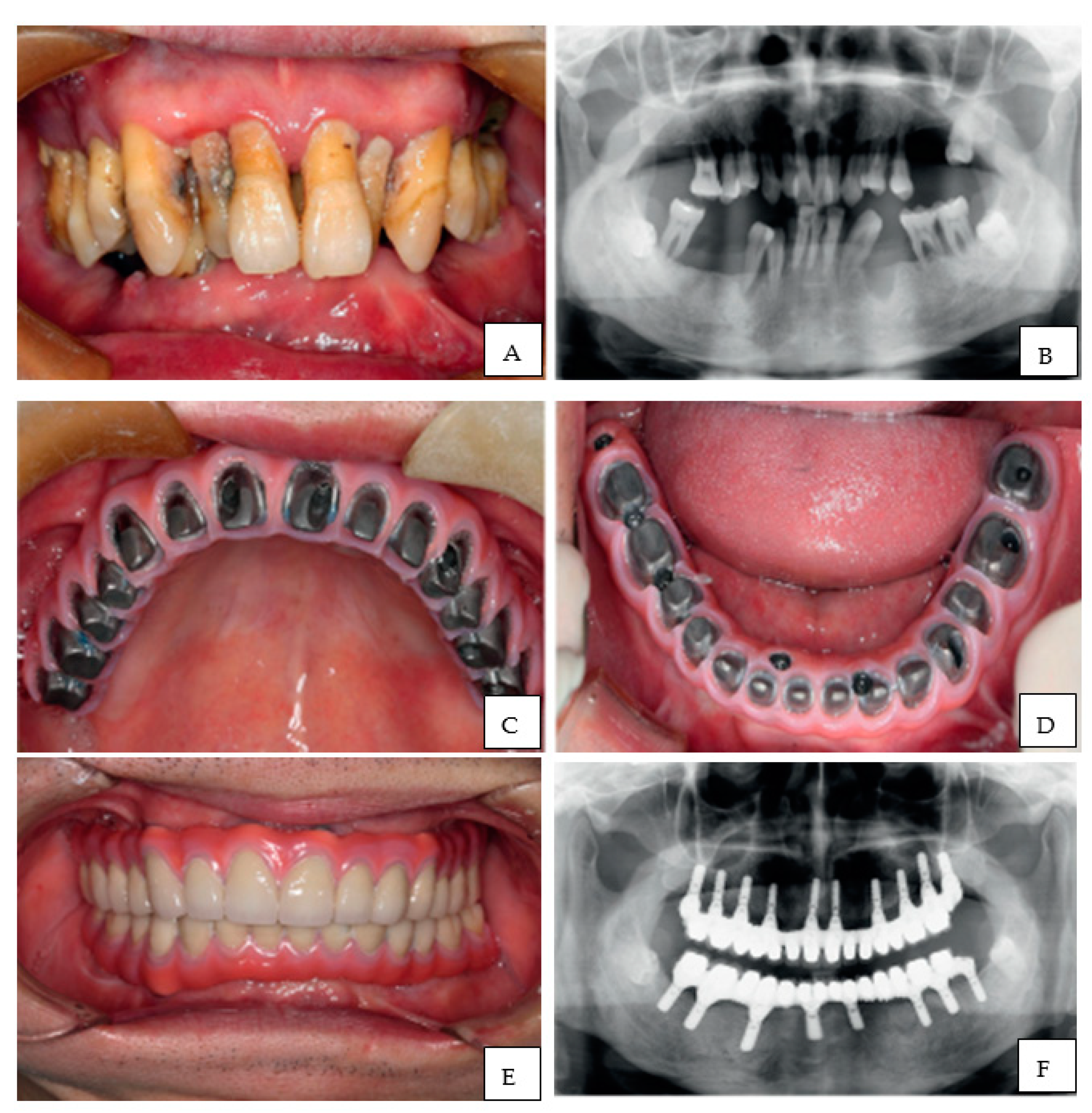 Polymers Free Full Text Dental 3d Printing Transferring Art From The Laboratories To The Clinics Html Polymers Free Full Text Dental 3d Printing Transferring Art From The Laboratories To The Clinics Html
