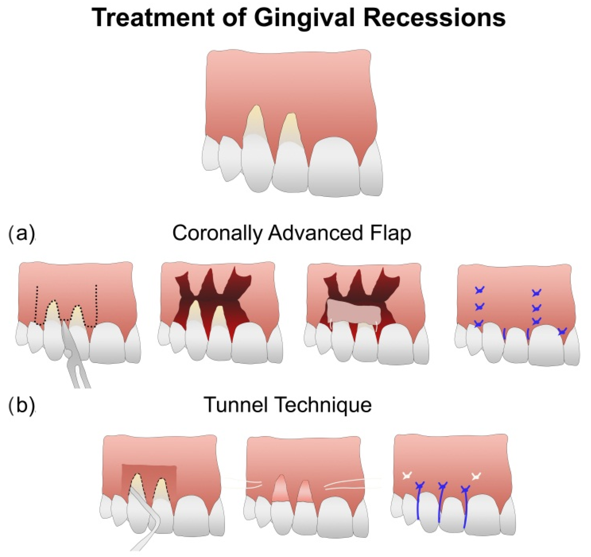 Polymers | free full-text | treating gingival recessions using