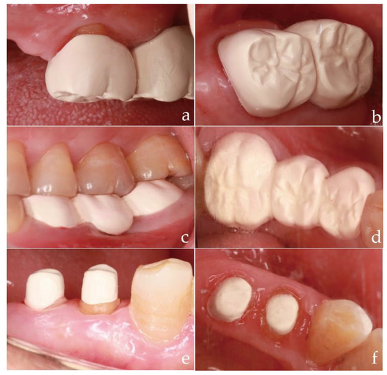 PEEK in Fixed Dental Prostheses: Application and Adhesion Improvement