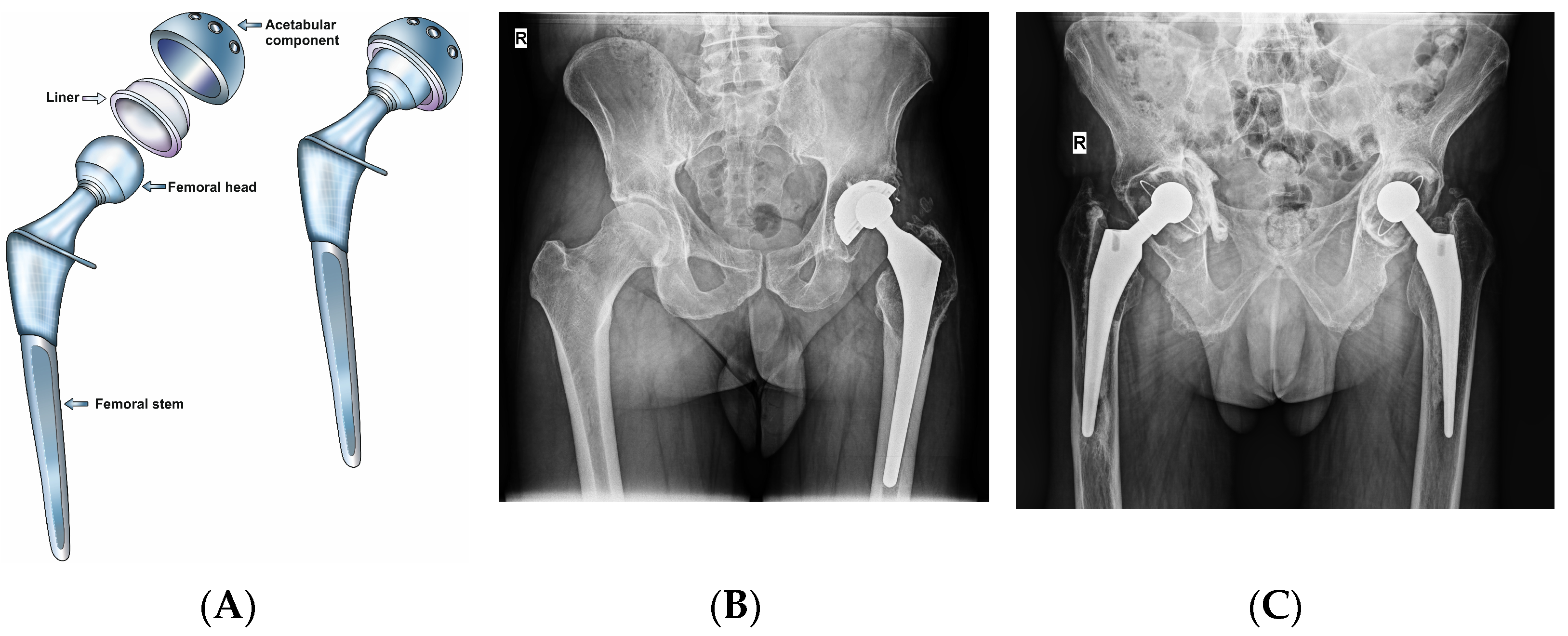 STEM: Press-Fit — Hip & Knee Book