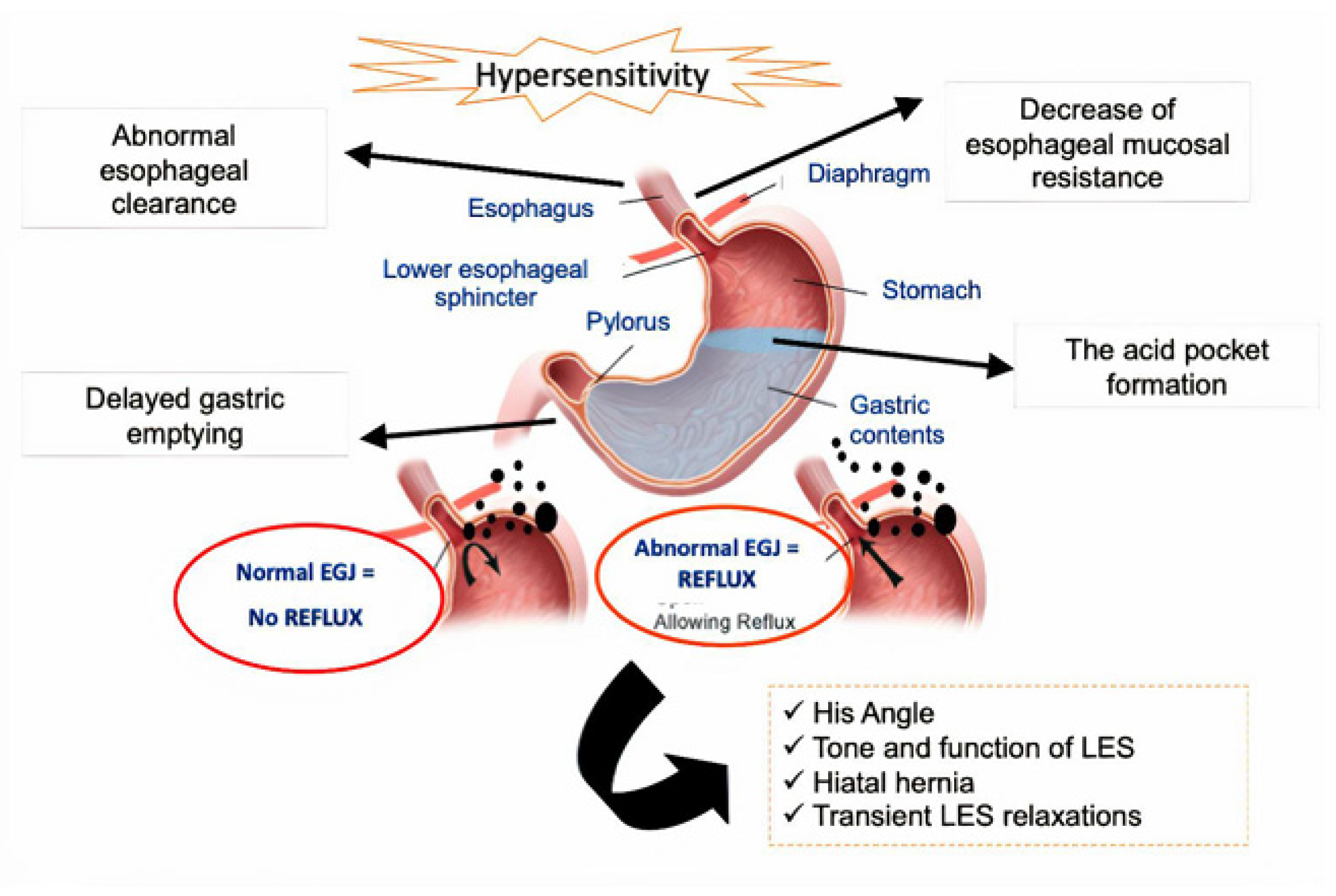 Can you naturally manage the acid pumps in stomach? Explore lifestyle changes that might help reduce acid production.