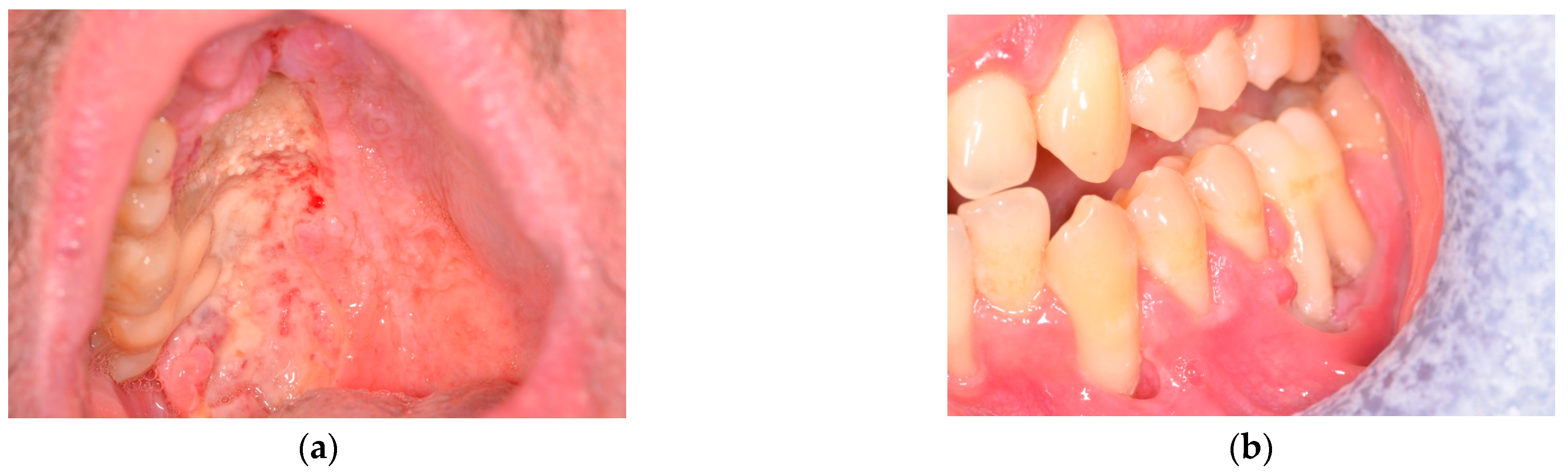 A Case of Intra Oral Bone Exposure of the Hard Palate A Clinical Diagnostic Dilemma