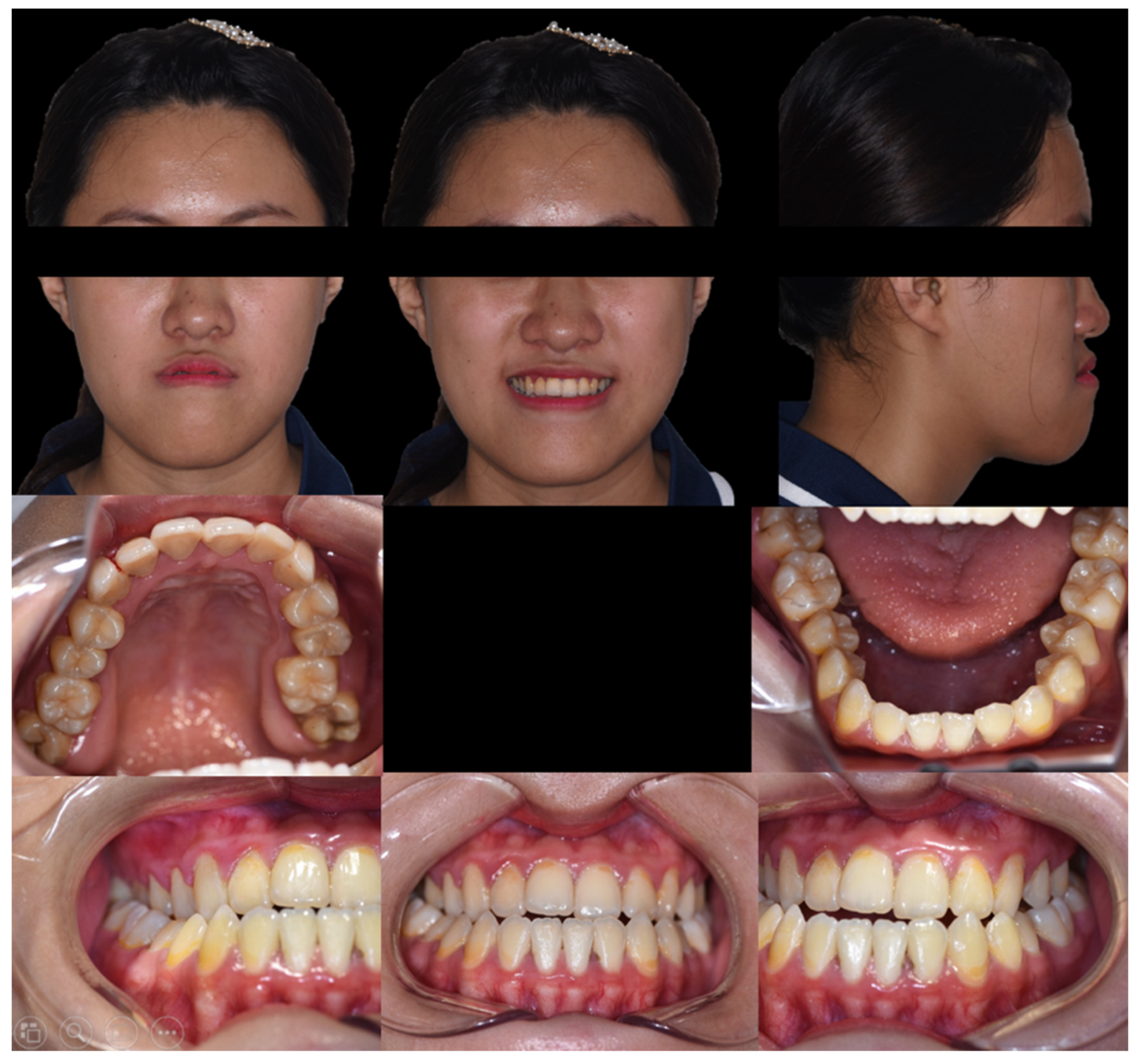 Advanced Digital 3D Technology in the Combined Surgery-First Orthognathic a...