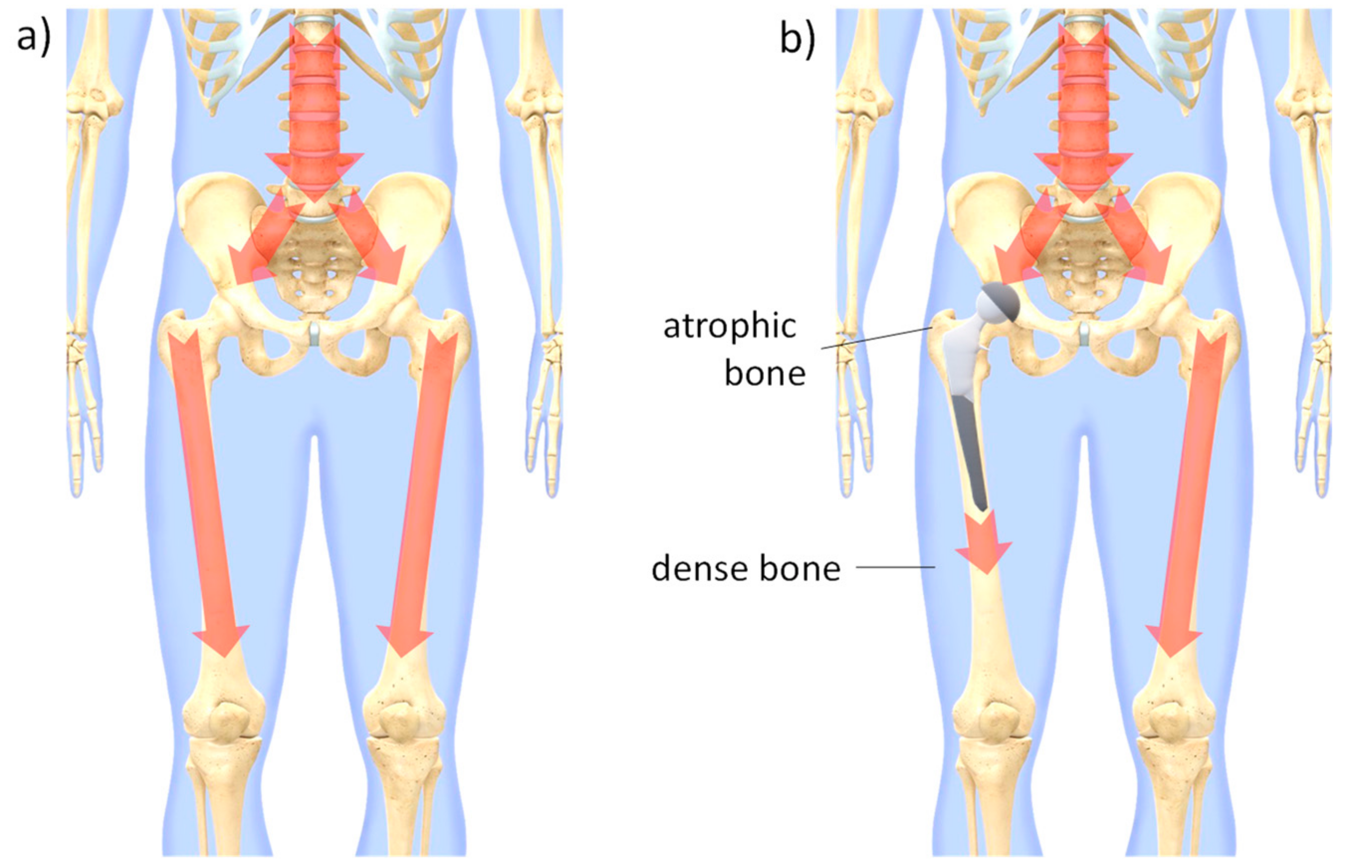 Processes Free Full Text When The Total Hip Replacement Fails A Review On The Stress Shielding Effect Html
