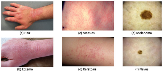 Machine Learning Methods in Skin Disease Recognition: A Systematic Review