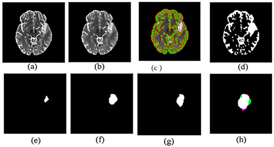 Automatic Active Contour Algorithm for Detecting Early Brain Tumors in ...