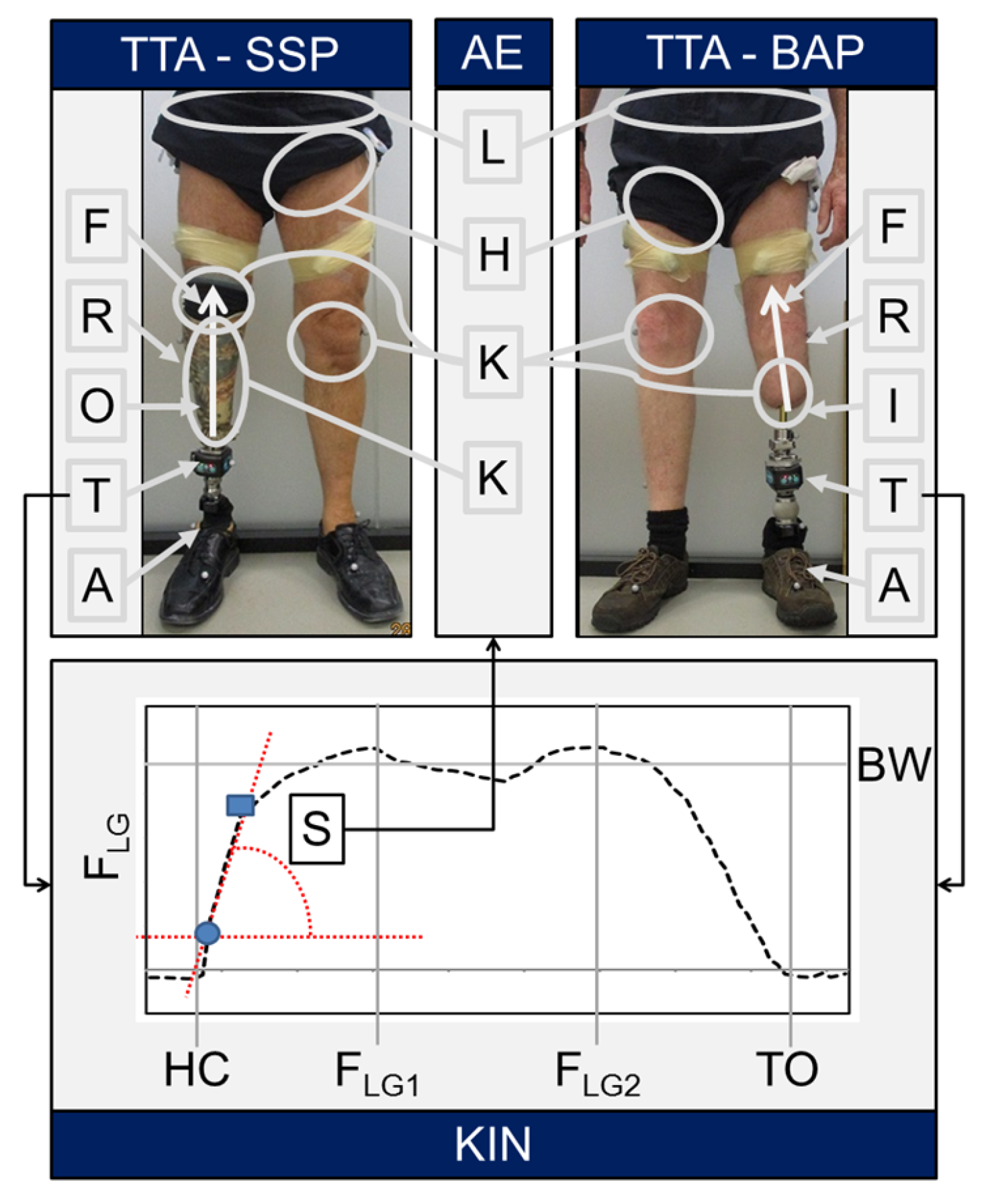 Above Knee Prosthetics, Above & Beyond Orthopedics