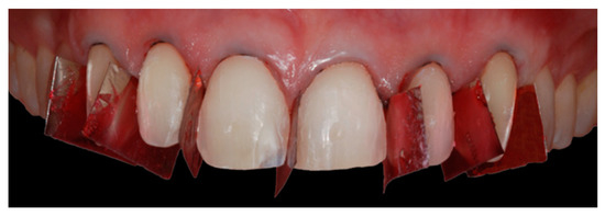 Definitive veneers and crowns prepared digitally using prosthetic