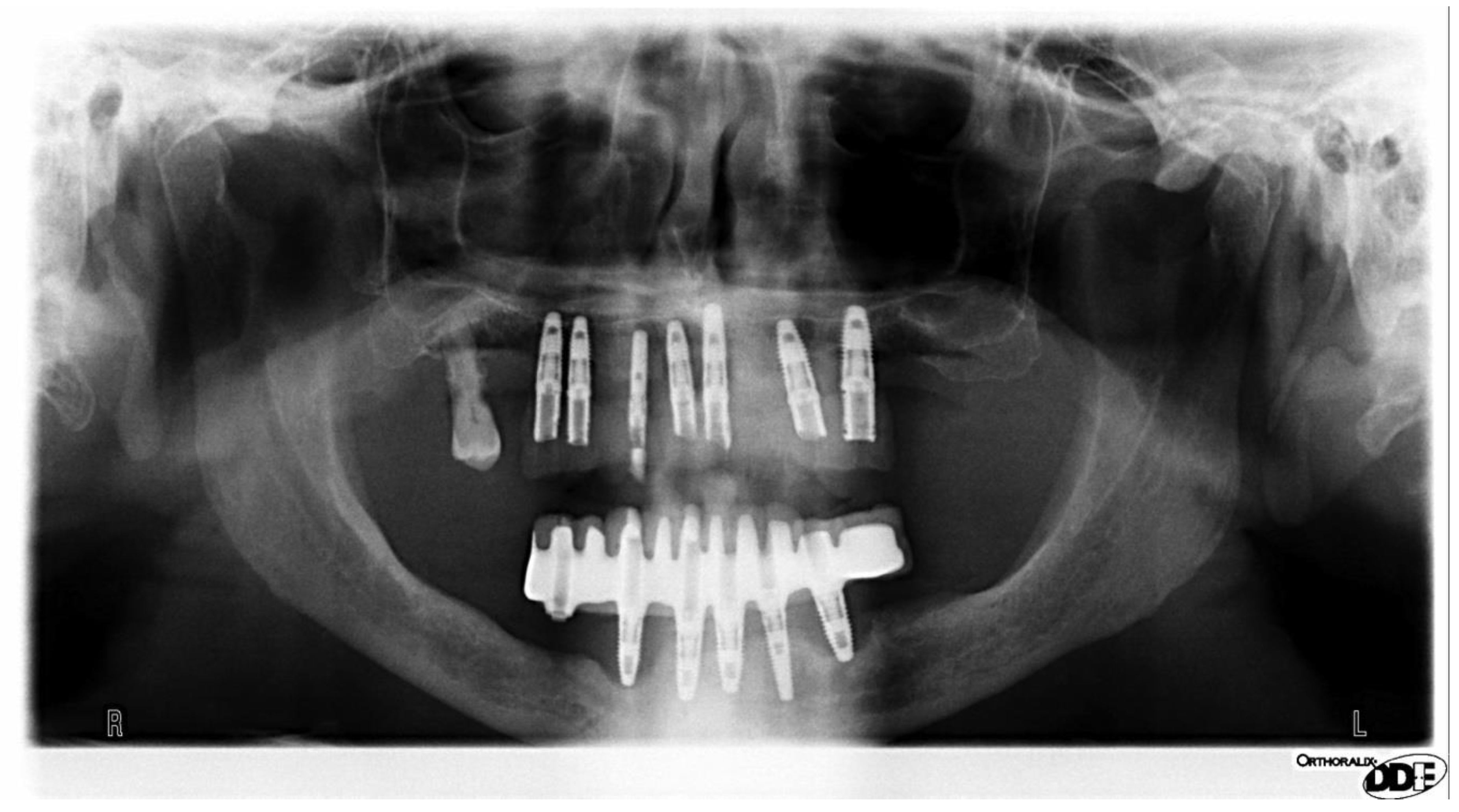 Prosthesis Free FullText Screwdriver Aspiration During Oral