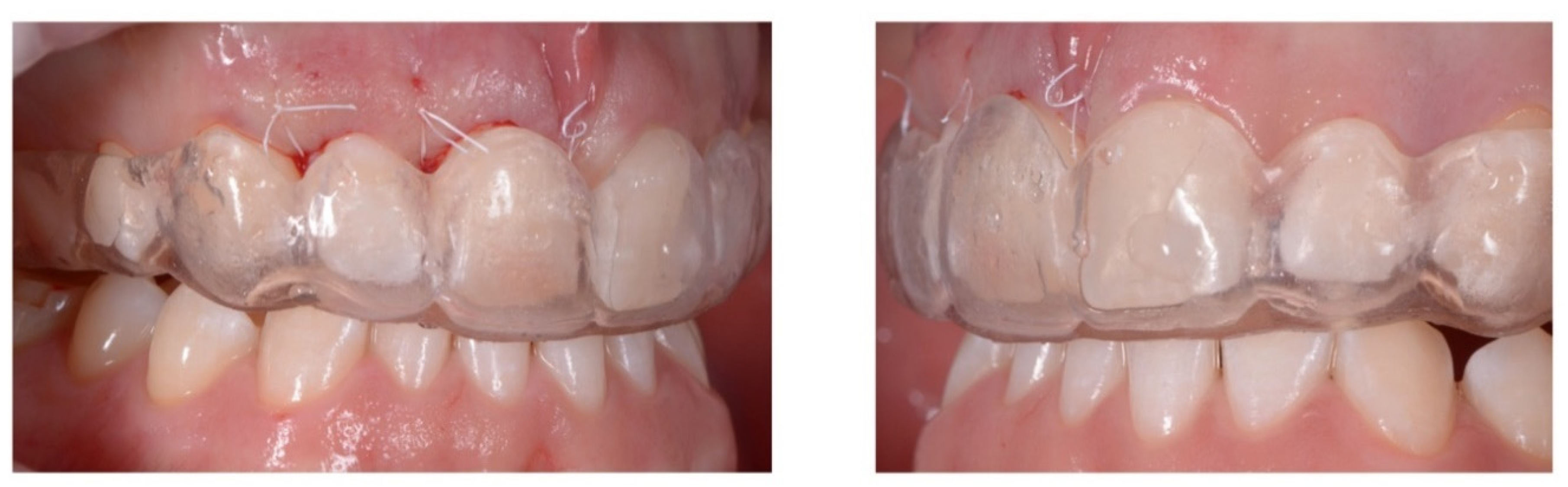 Prosthesis 02 00017 g010 Prosthesis 02 00017 g010