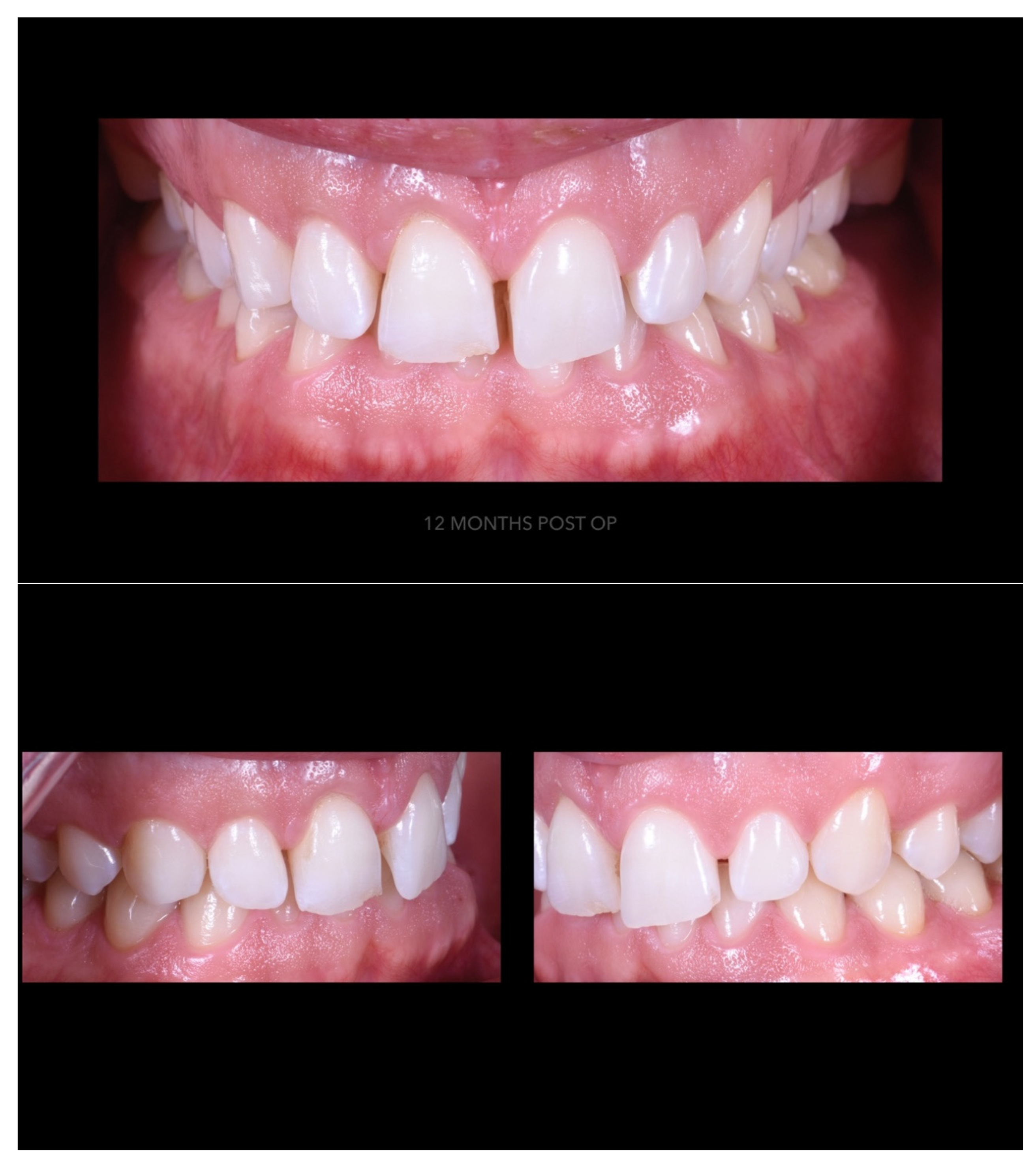 Prosthesis 02 00017 g011 Prosthesis 02 00017 g011