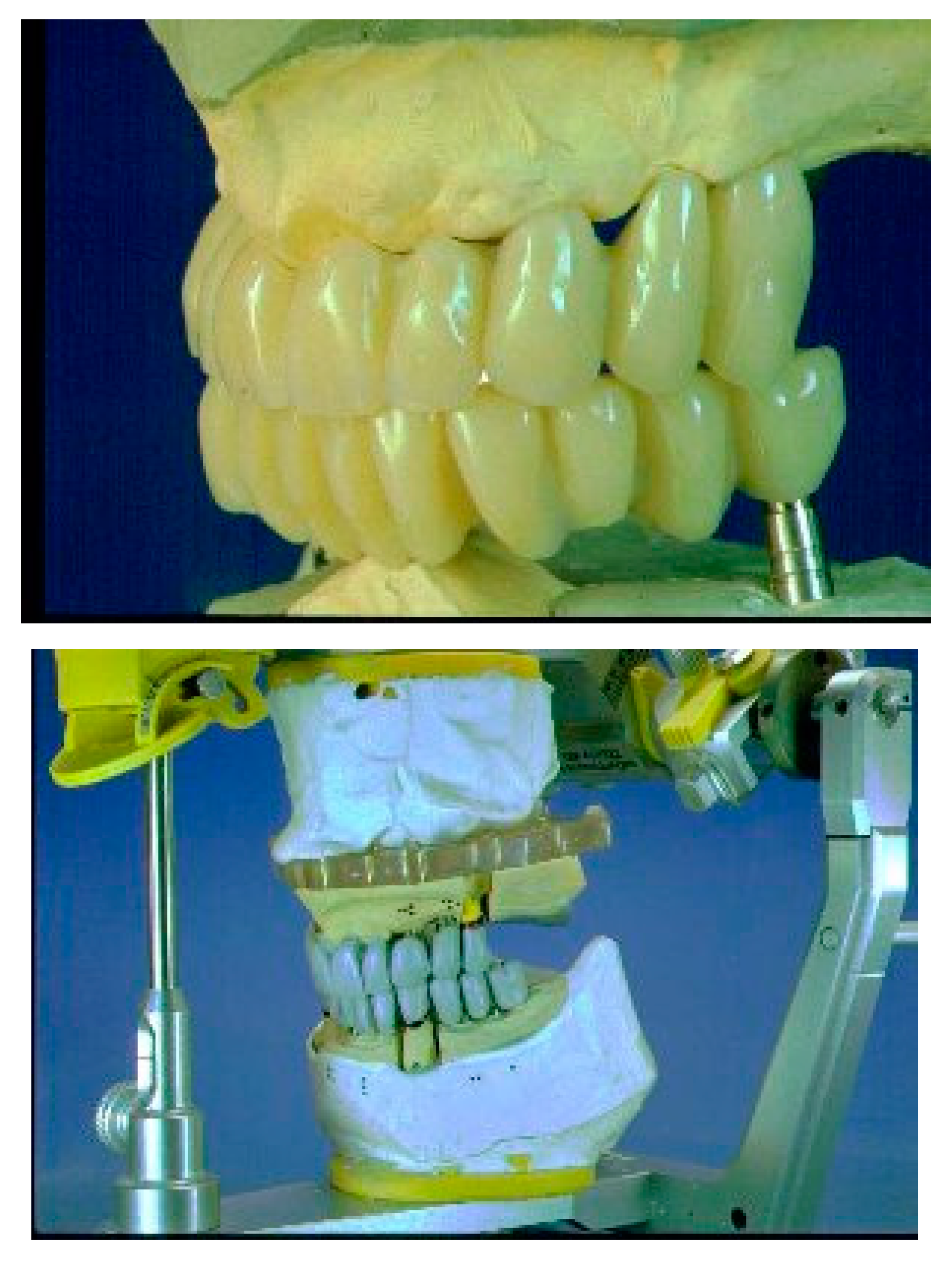 Prosthesis Free FullText Occlusal Load Considerations in Implant
