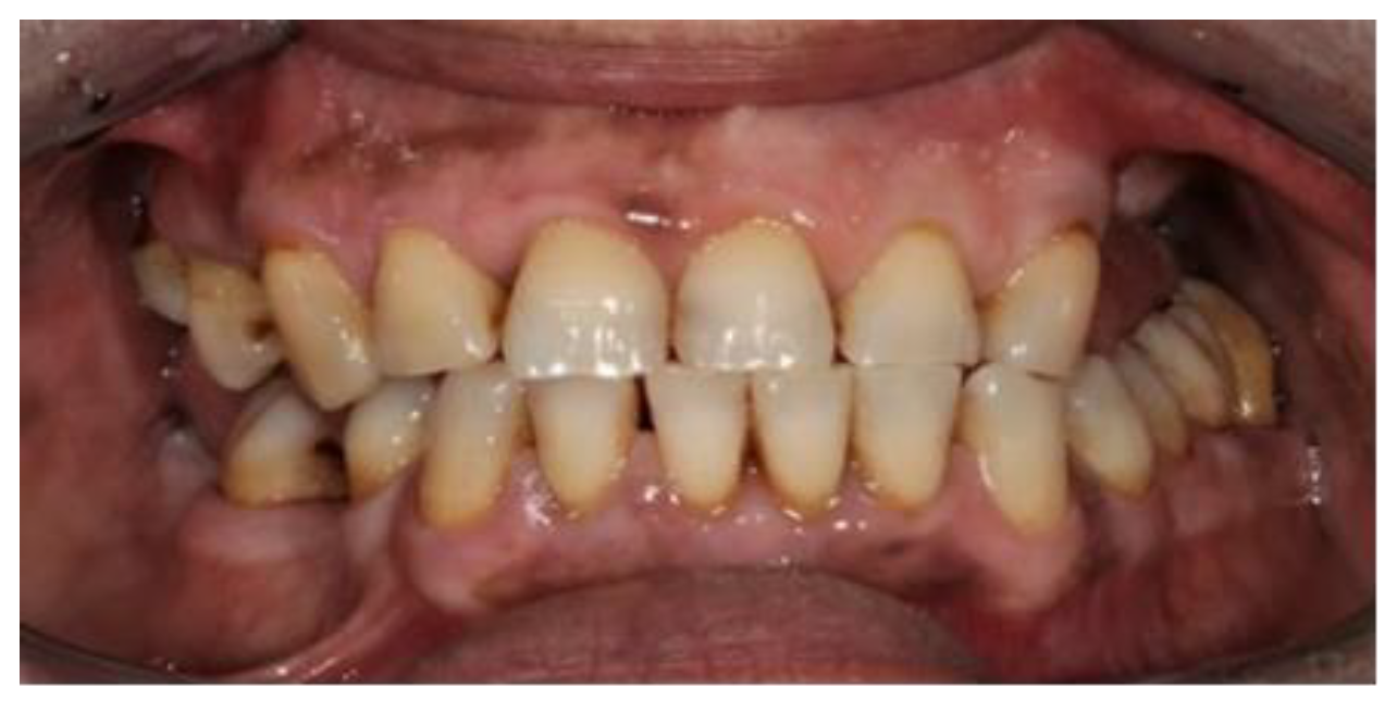 Prosthesis Free FullText Construction of a Removable Partial