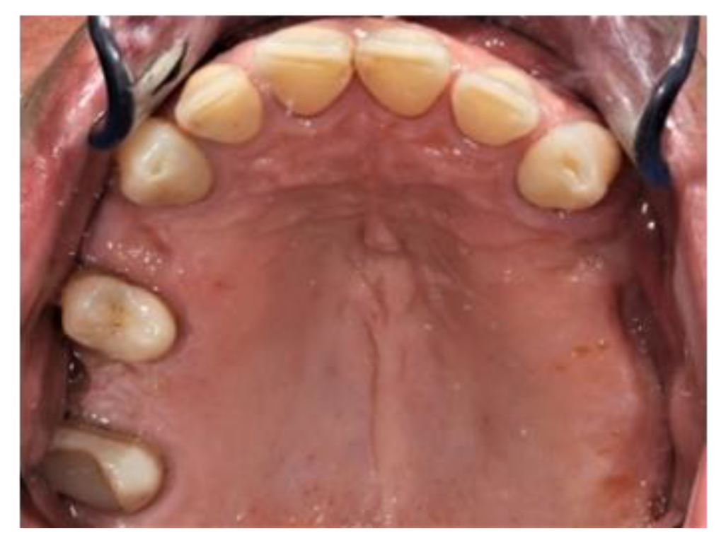 Prosthesis Free FullText Construction of a Removable Partial