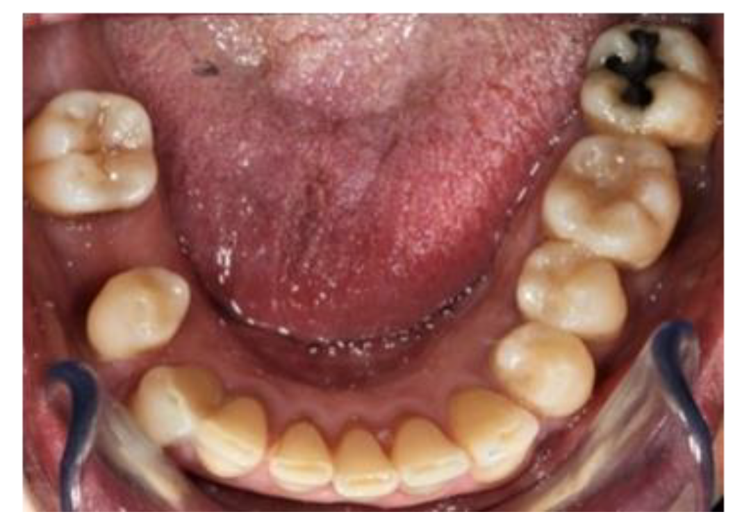 Prosthesis Free FullText Construction of a Removable Partial