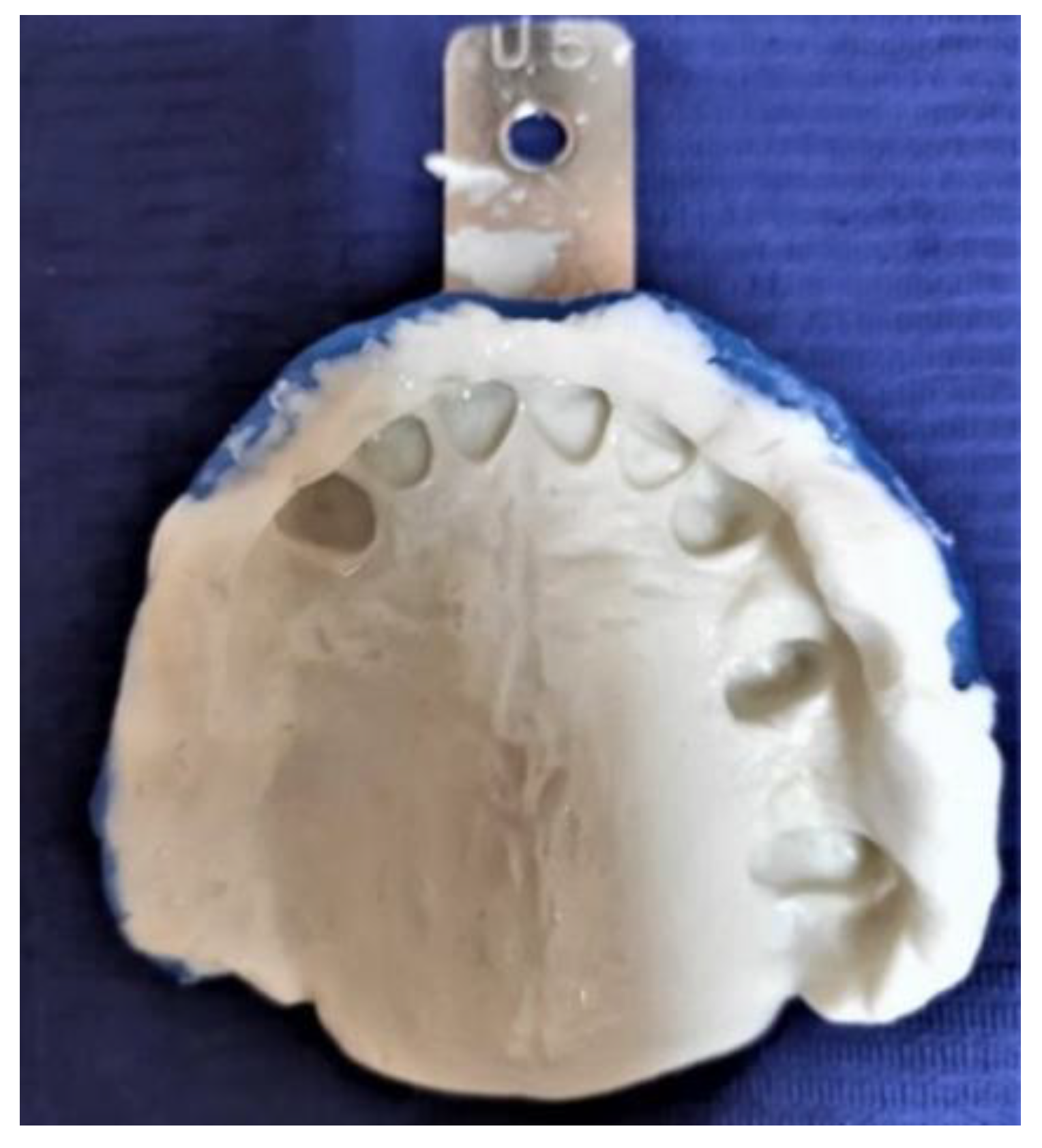 Prosthesis Free FullText Construction of a Removable Partial