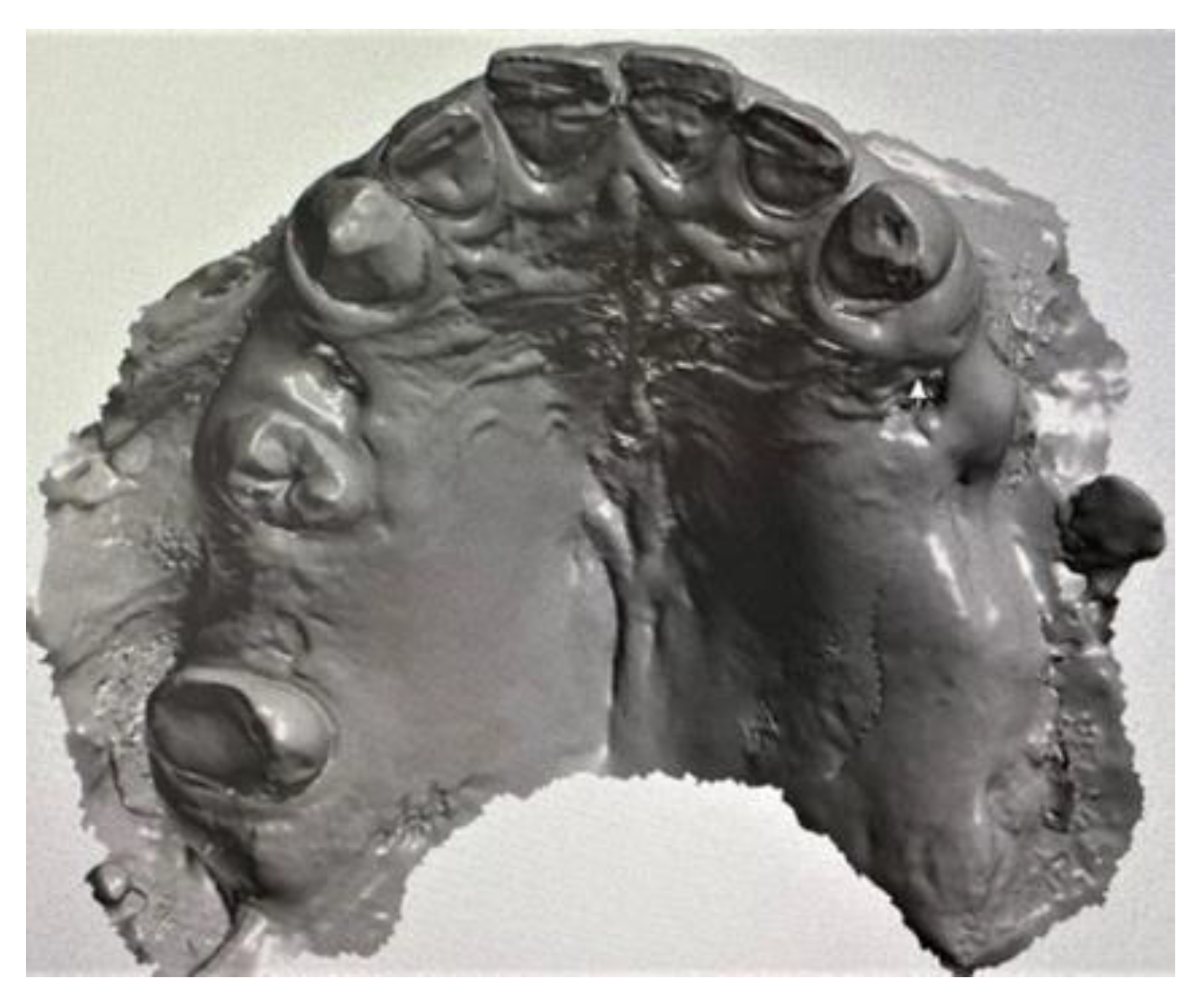 Prosthesis Free FullText Construction of a Removable Partial