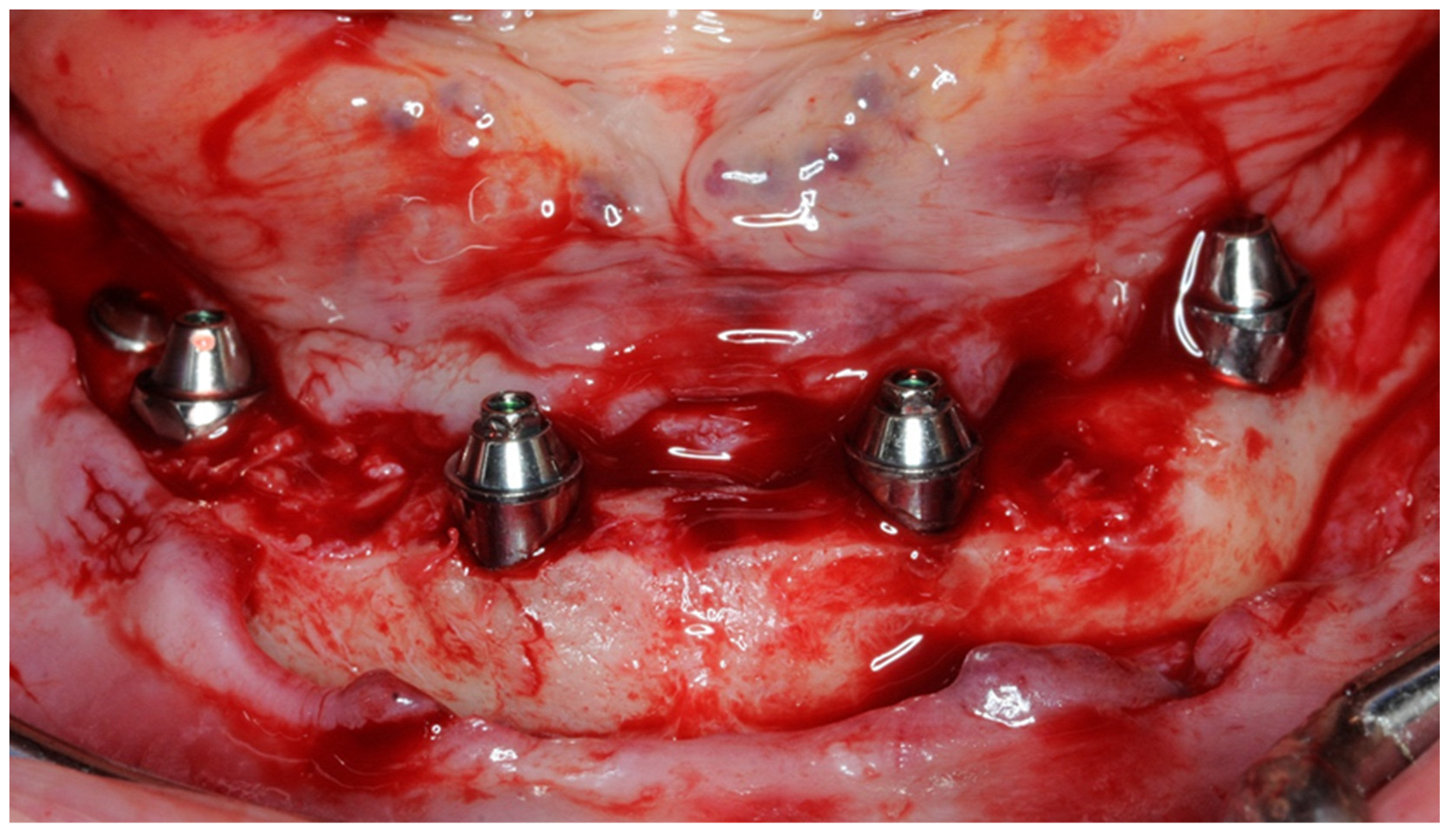 Prosthesis 04 00002 g001