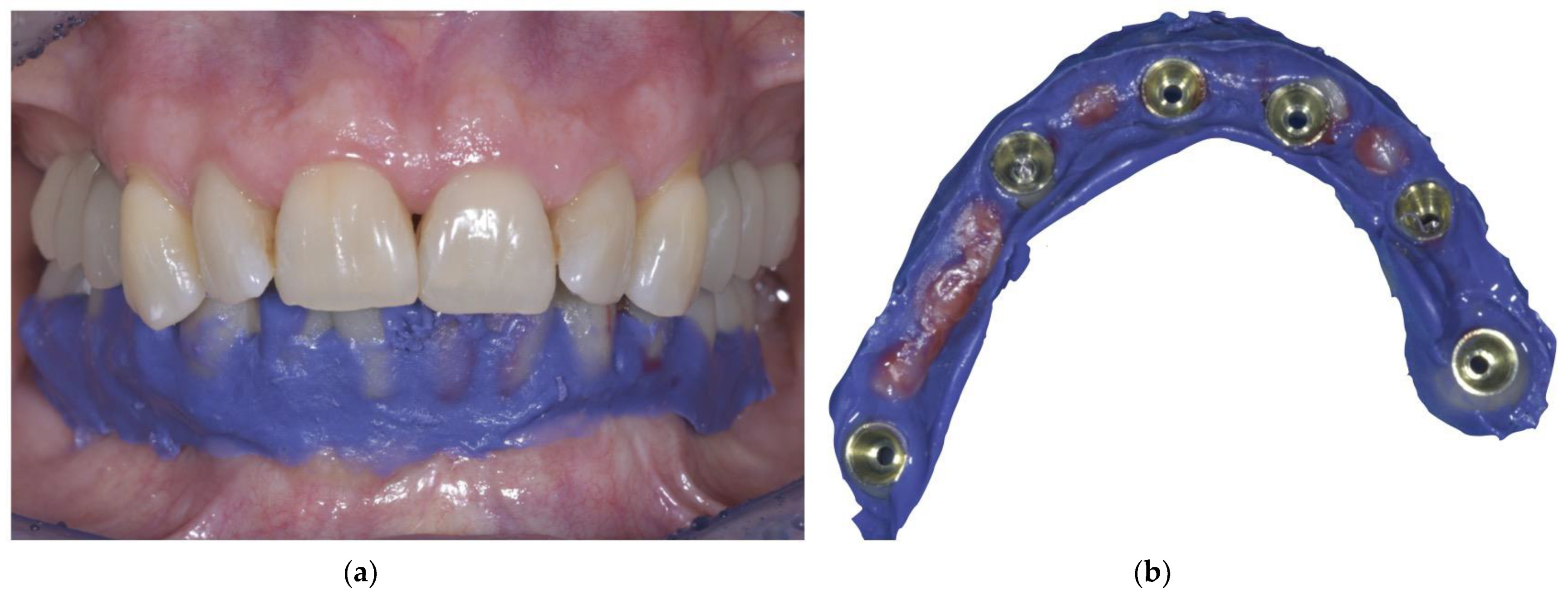 Prosthesis Free FullText FullArch, ImplantFixed Complete