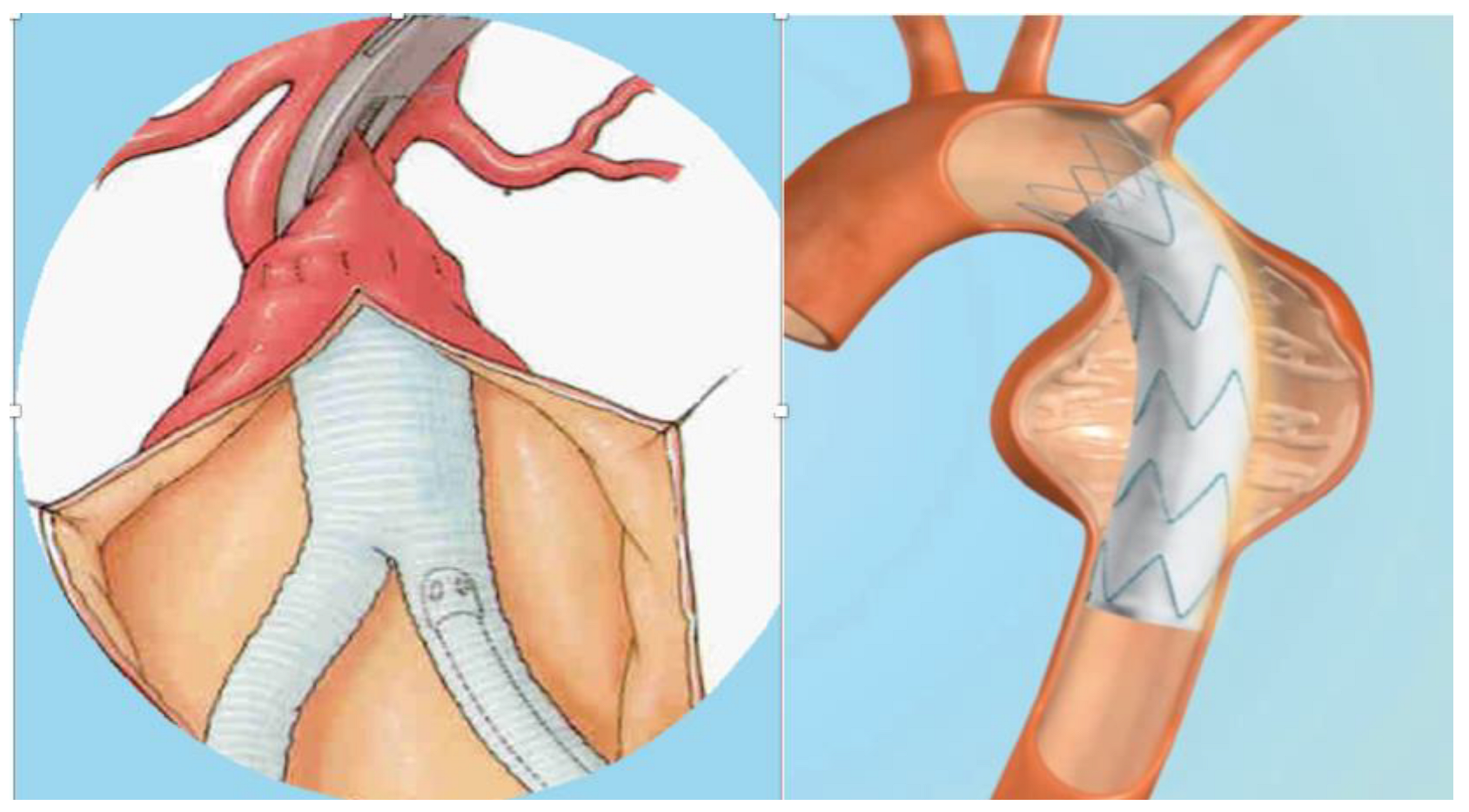 Prosthesis Free FullText Infection of Vascular Prostheses A Comprehensive Review
