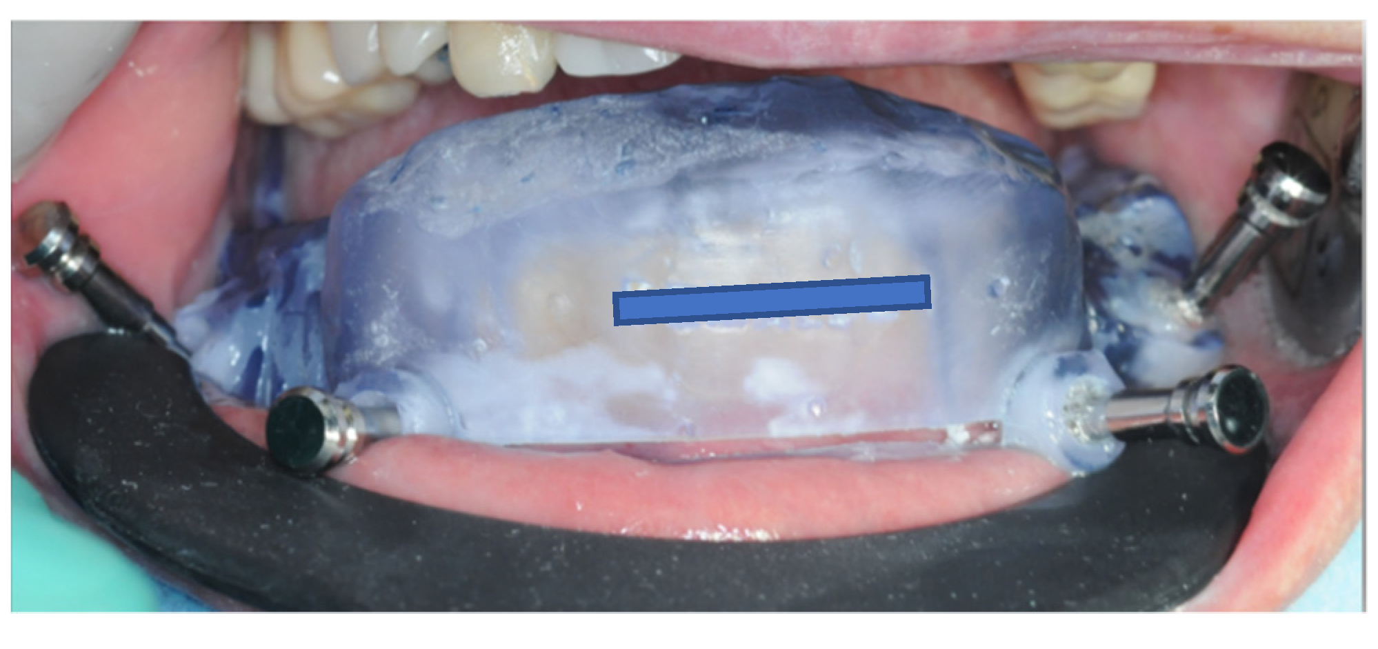 Prosthesis 05 00017 g009 Prosthesis 05 00017 g009