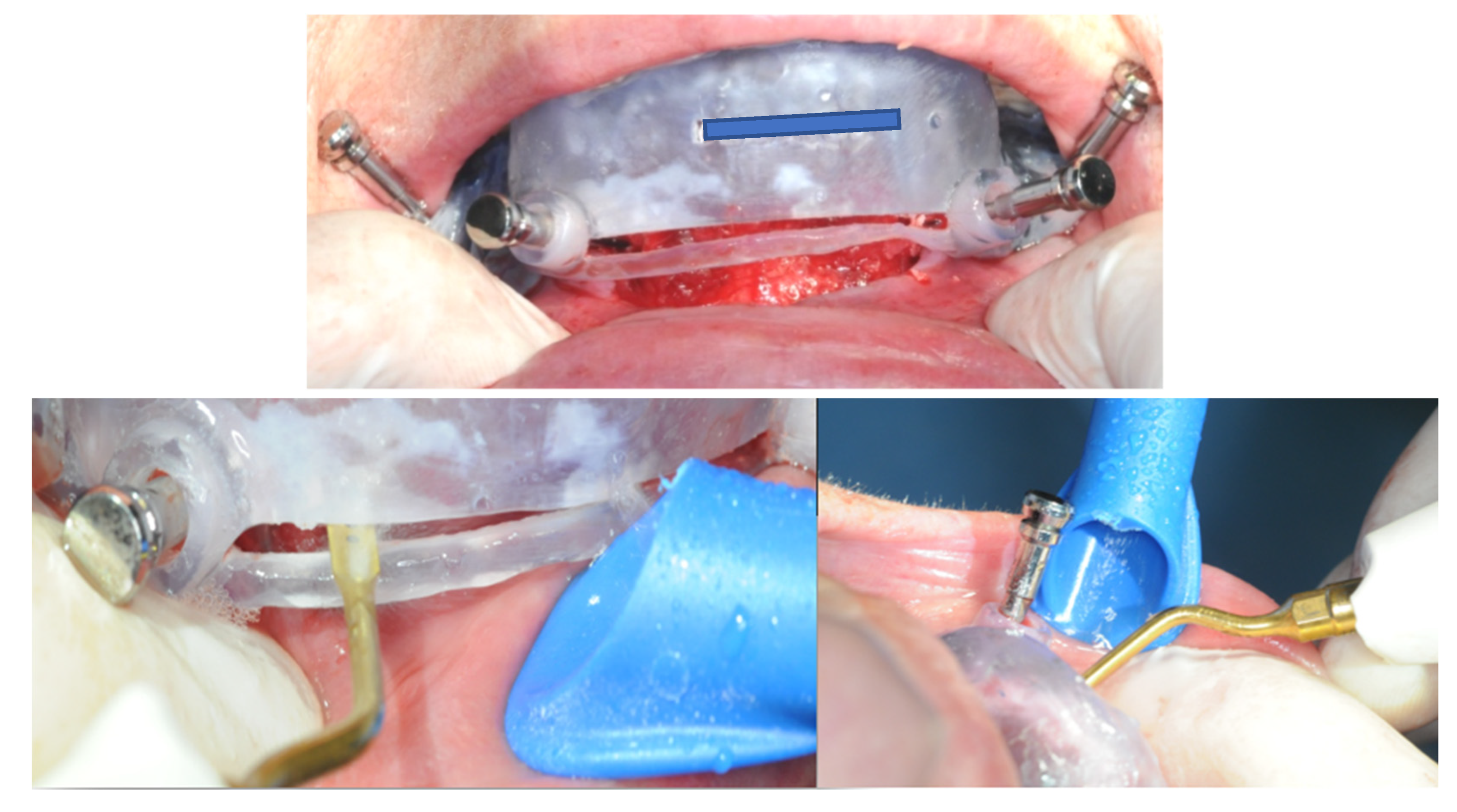 Prosthesis 05 00017 g011 Prosthesis 05 00017 g011