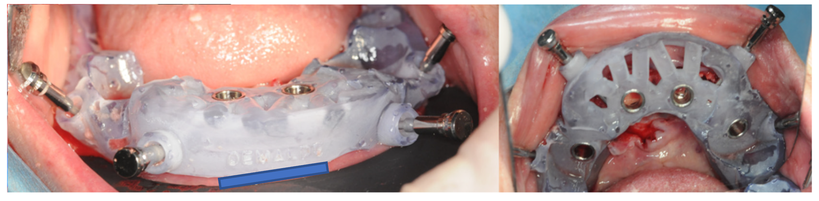 Prosthesis 05 00017 g012 Prosthesis 05 00017 g012