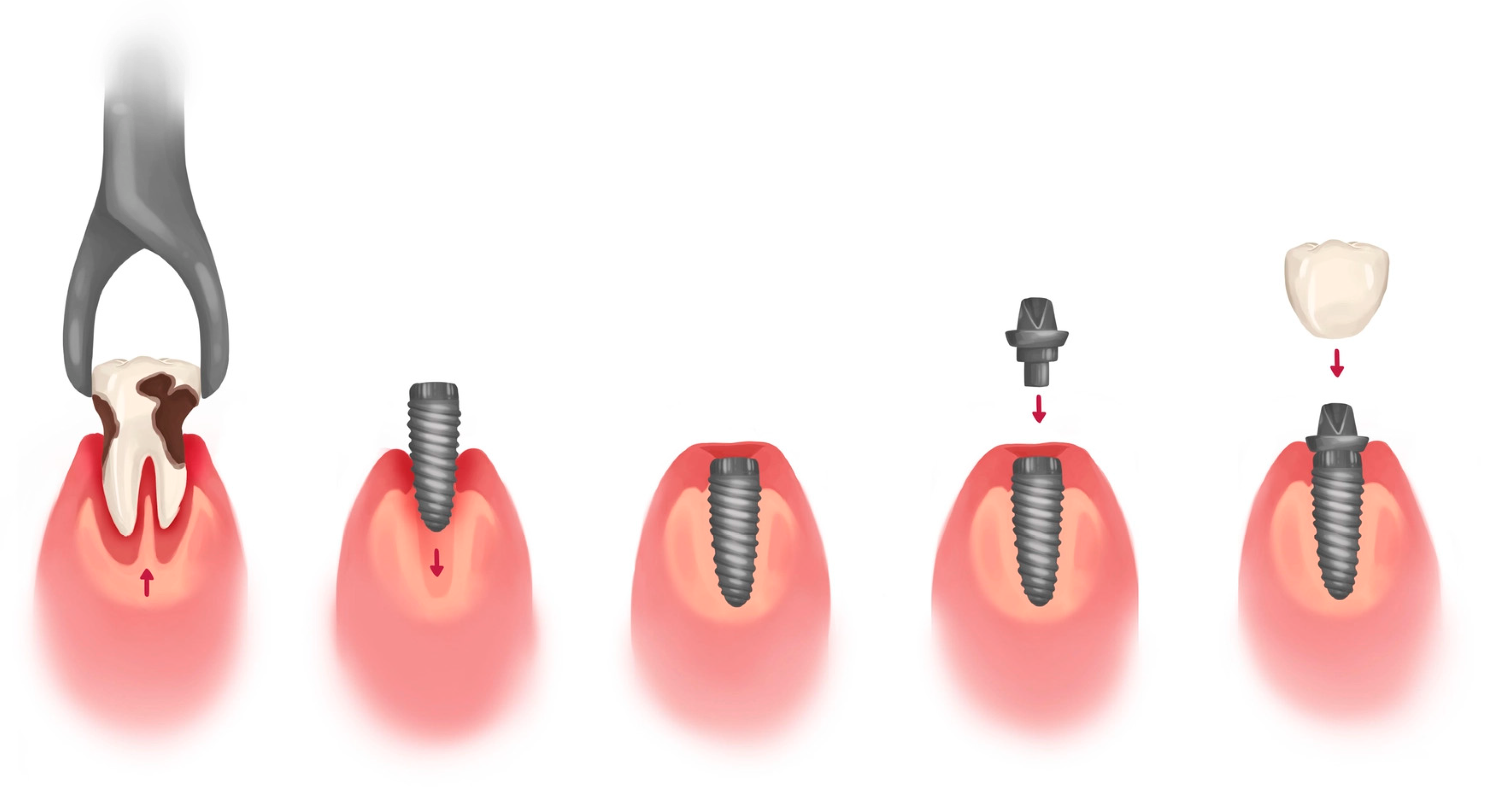 Prosthesis 05 00018 g002 Prosthesis 05 00018 g002