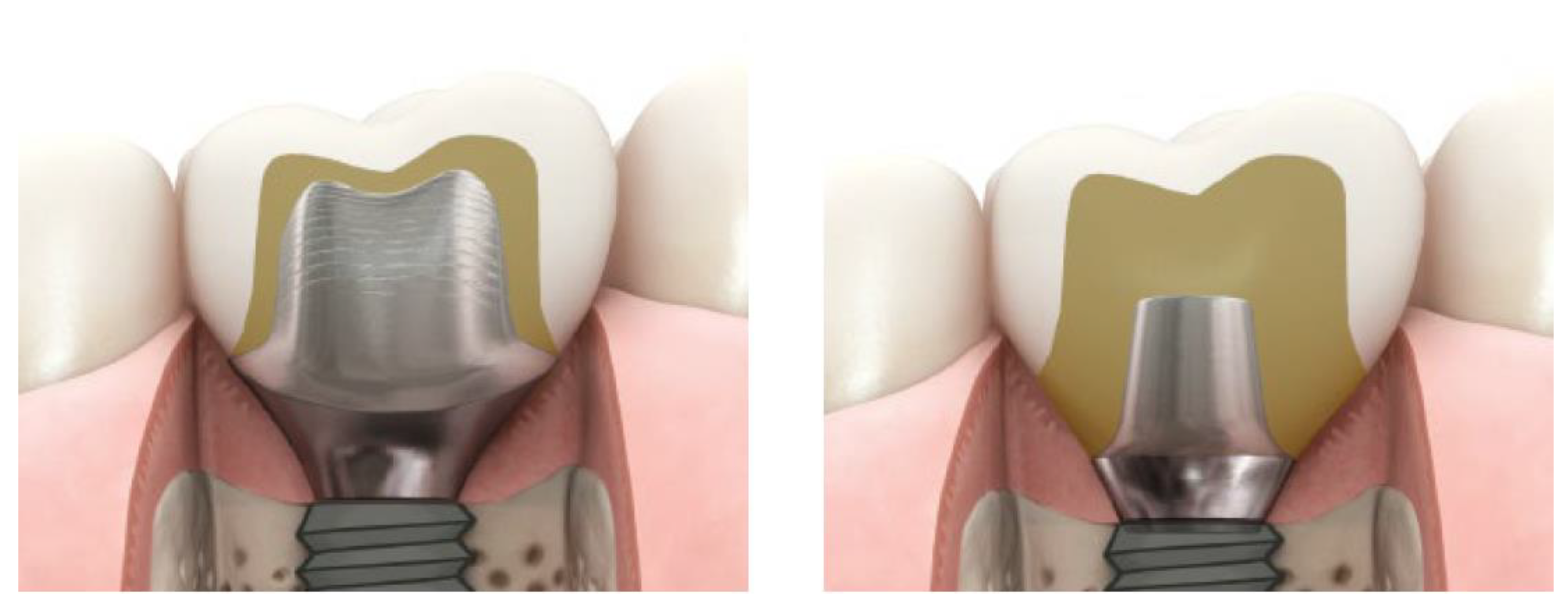 Prosthesis Free FullText Radiological and Periodontal Evaluation