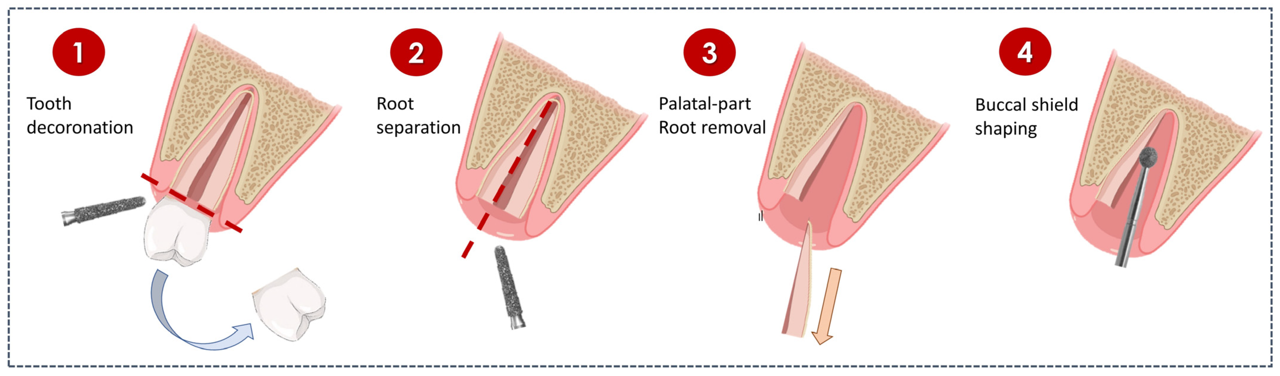 Prosthesis Free FullText Socket Shield Technique to Improve the