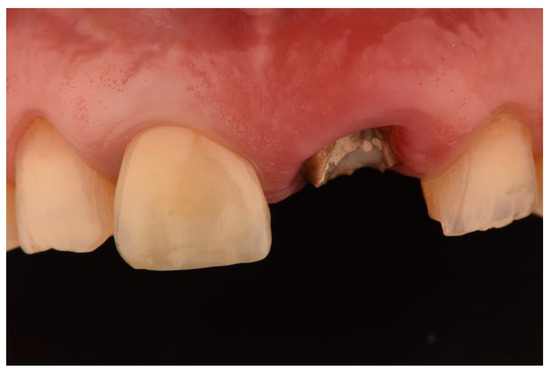 Projecting Tooth Single Crown Restorations Supported by One-Piece Zirconia Dental ...