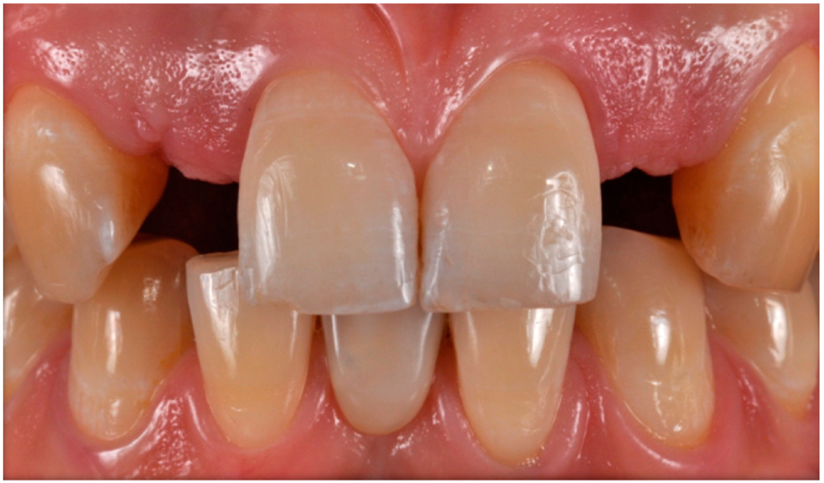 Prosthesis | Free Full-Text | Presenting a Protocol for Dental Implant  Restorations