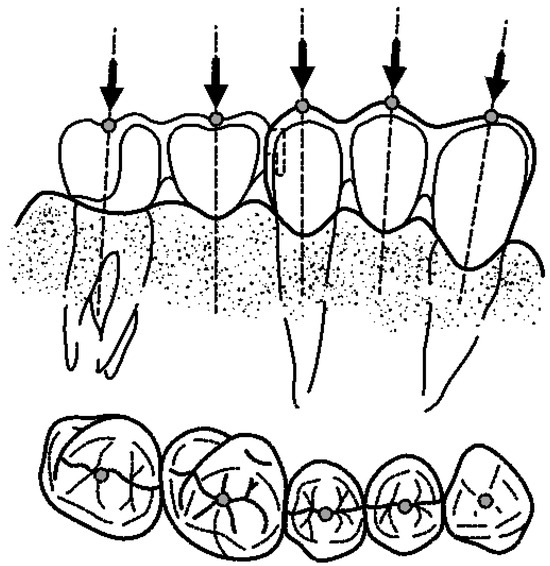 Prosthesis Free FullText Extensometry Study of the Most