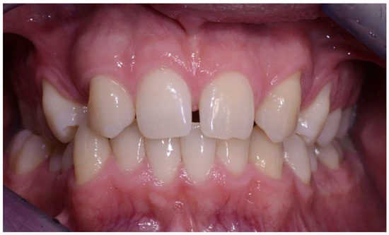 Implant-Prosthetic Rehabilitation of the Agenesis of Maxillary