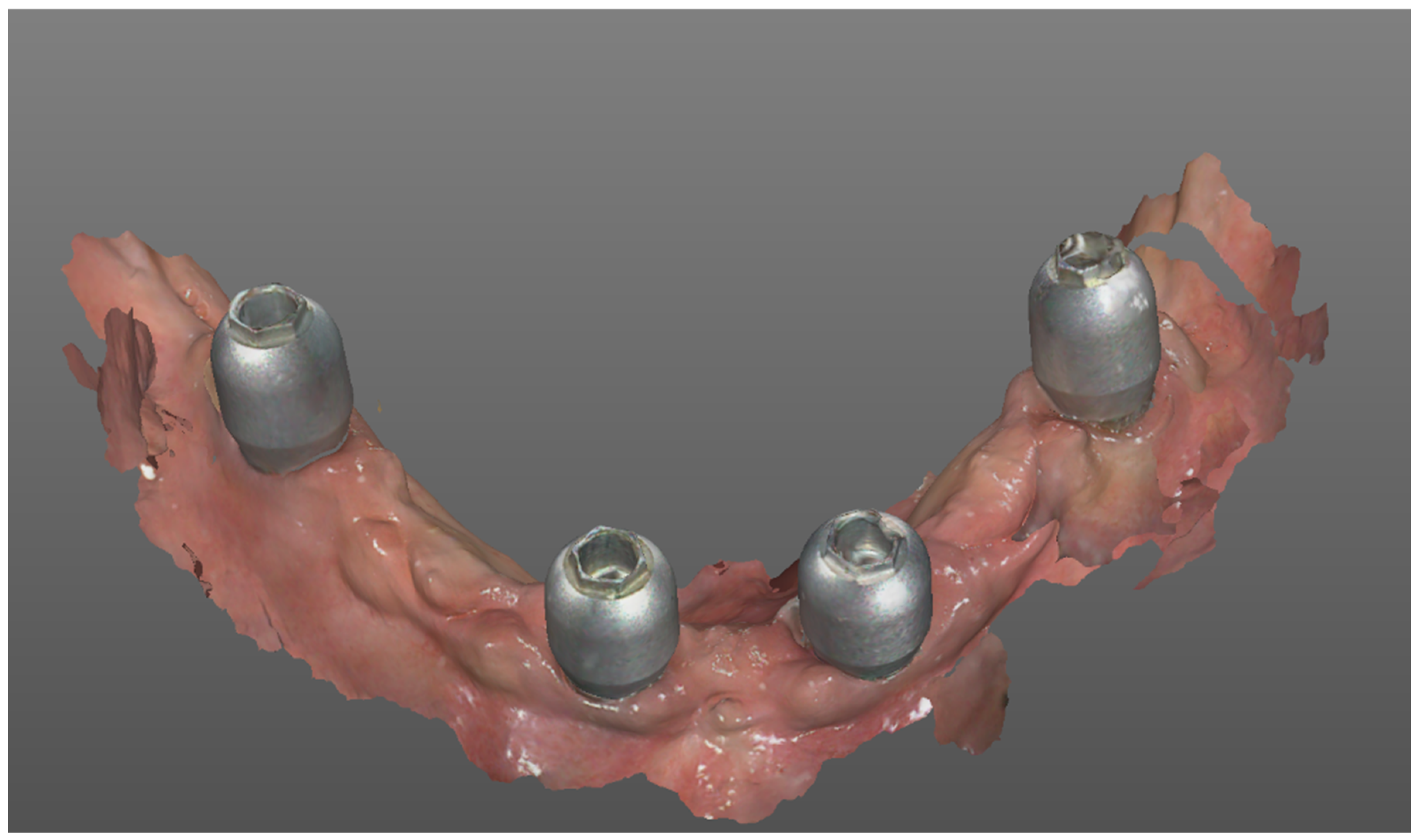 Comparison of Full-Arch Intraoral Scans Immediately After Implant
