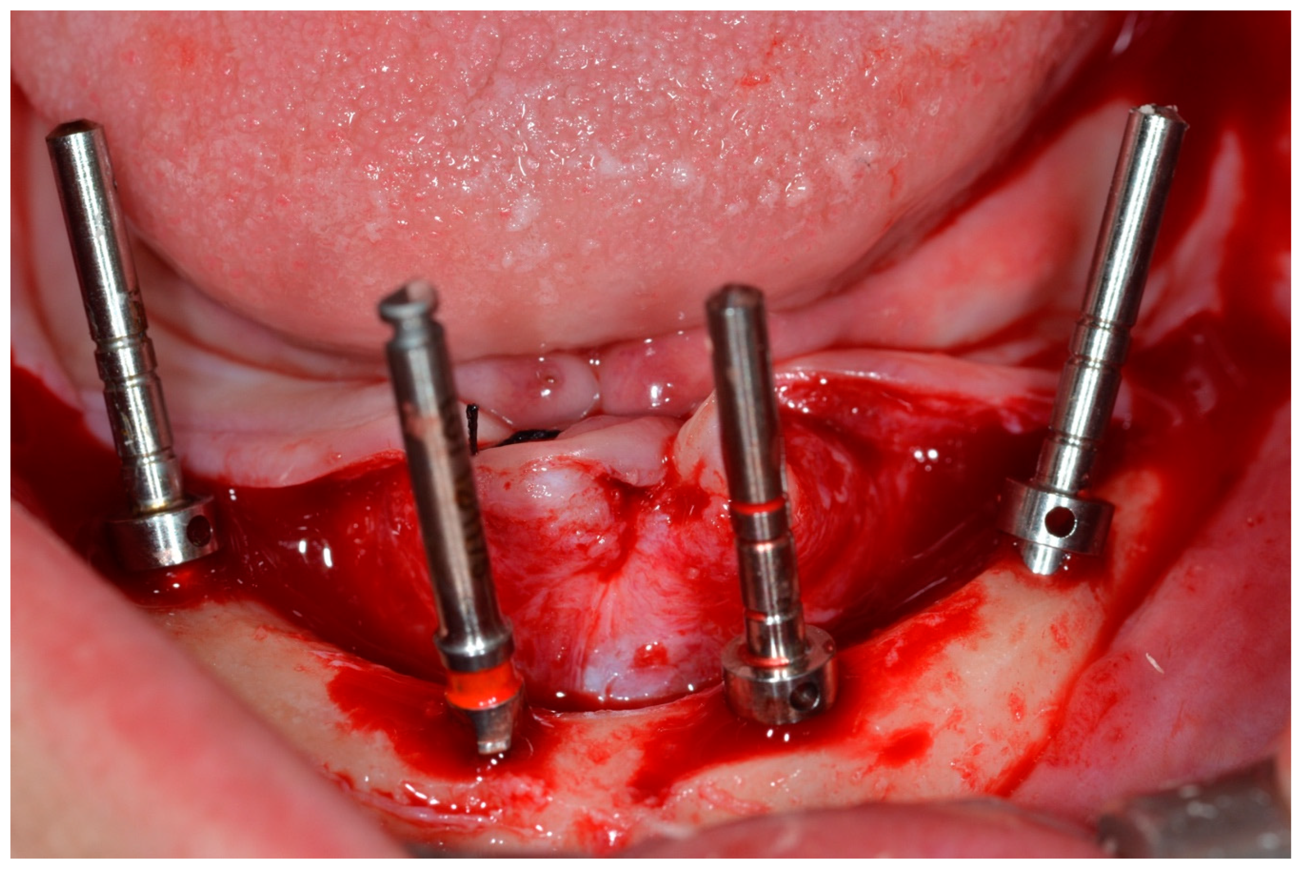 Prosthesis 07 00009 g004 Prosthesis 07 00009 g004