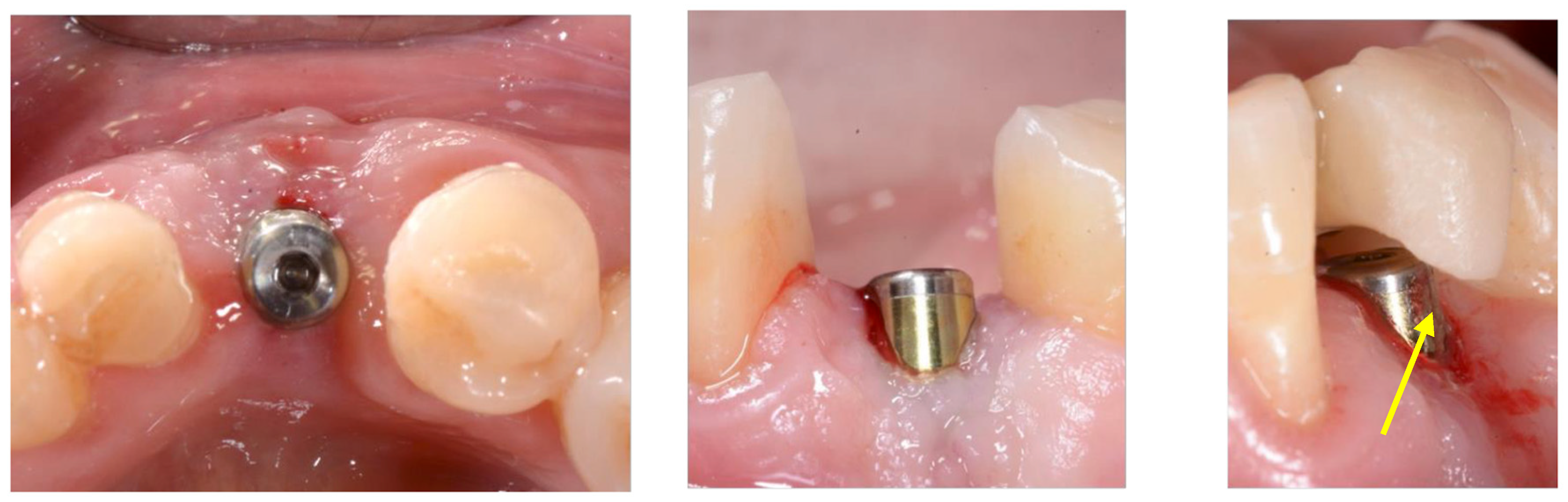 Prosthesis 07 00117 g004 Prosthesis 07 00117 g004