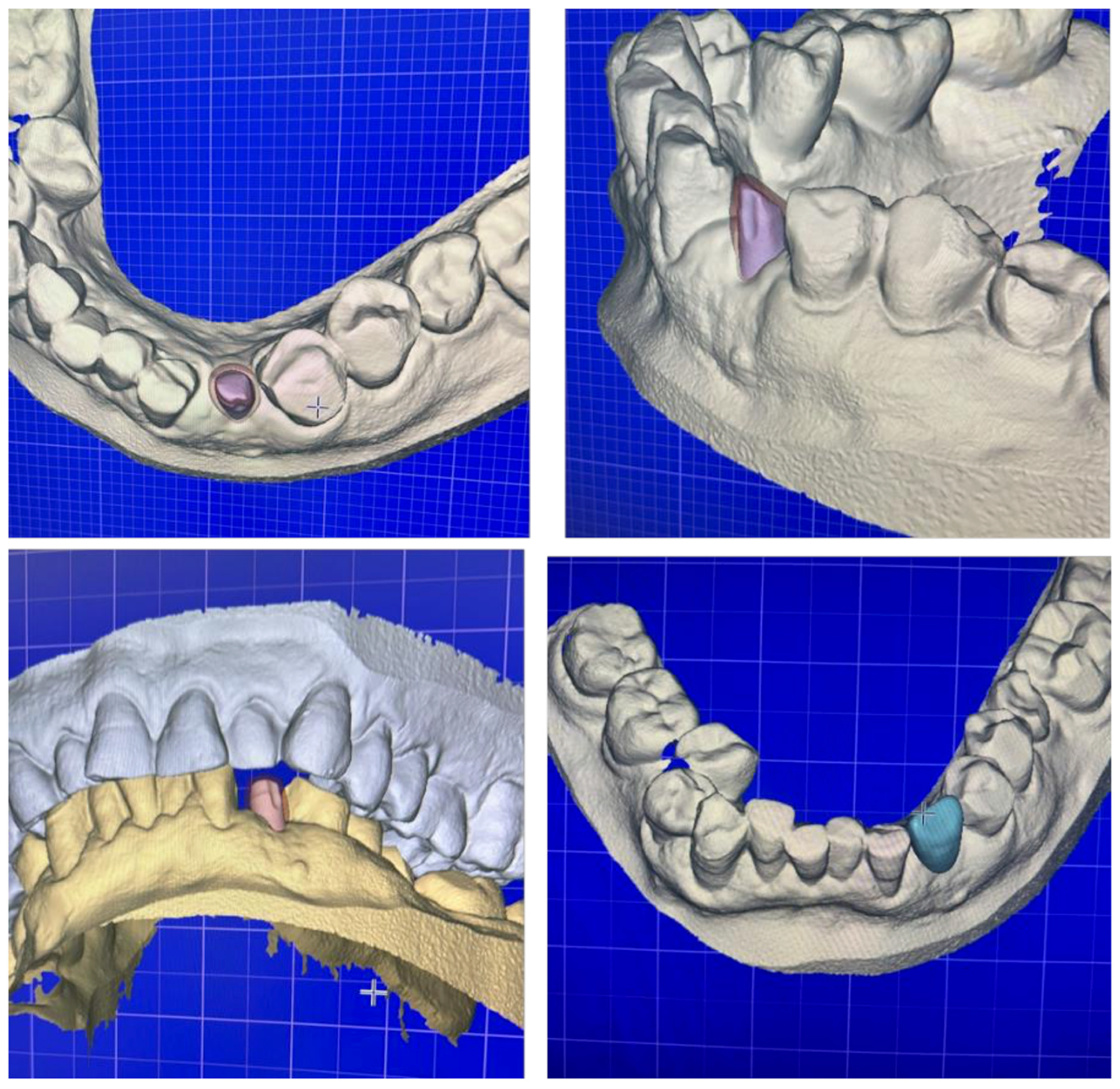Prosthesis 07 00117 g006 Prosthesis 07 00117 g006