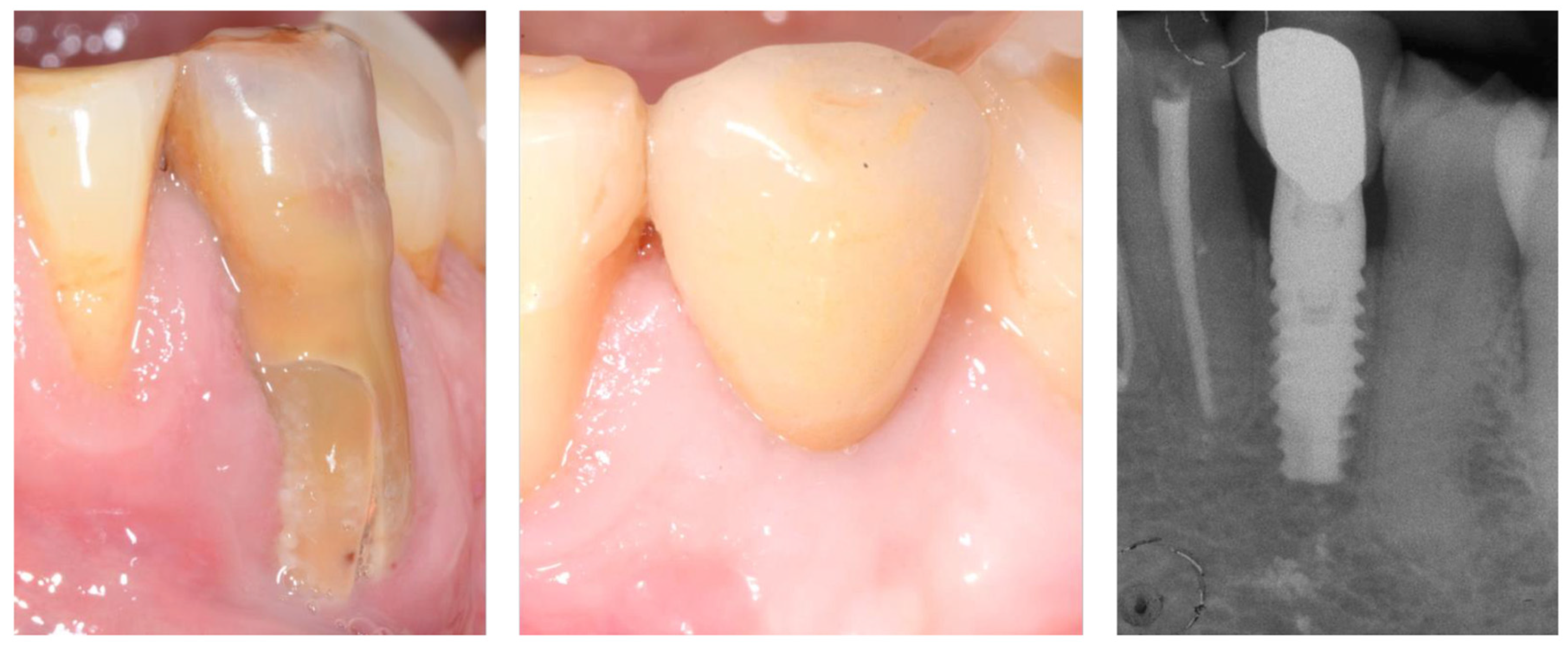 Prosthesis 07 00117 g009 Prosthesis 07 00117 g009