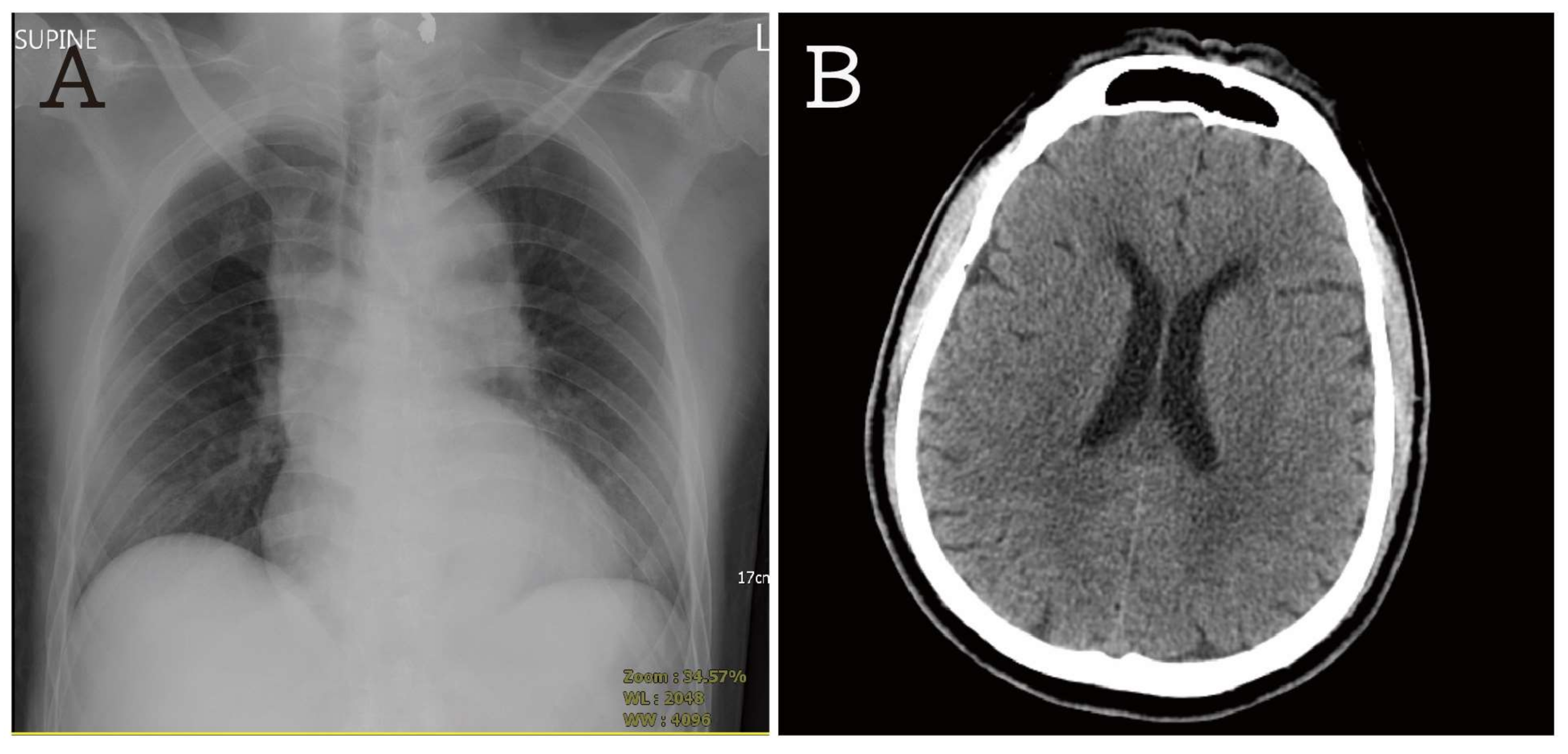Aortic Dissection X Ray