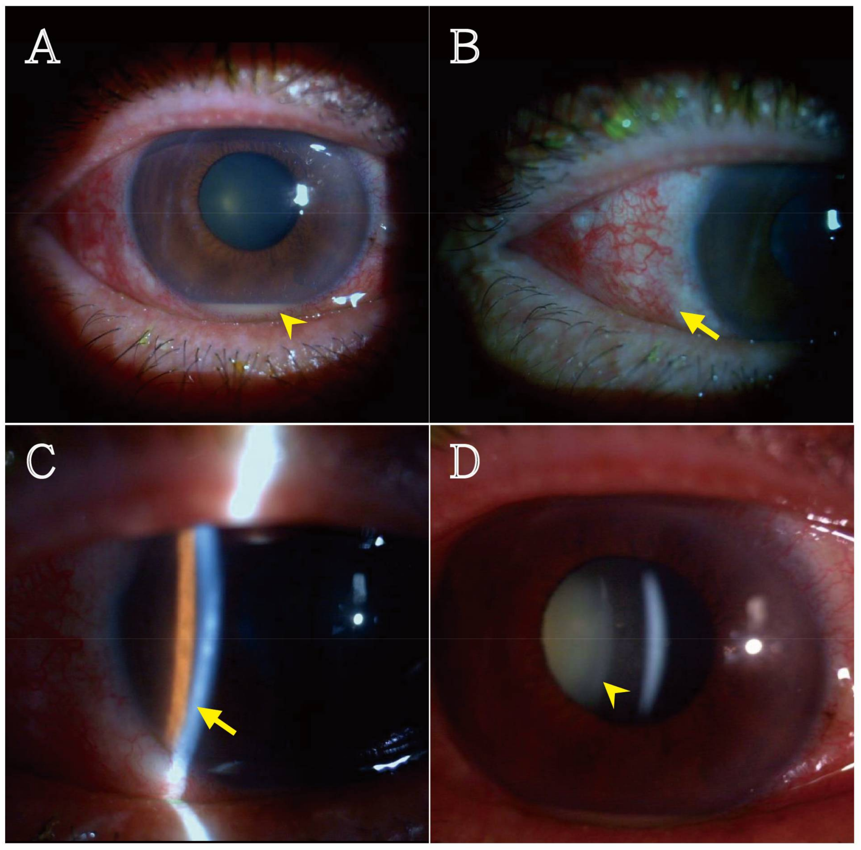 Reports | Free Full-Text | Klebsiella pneumoniae-Induced Multiple Infections  in a Diabetes Mellitus Patient: Pneumonia, Liver Abscess, Endogenous  Endophthalmitis, Urinary Tract Infection