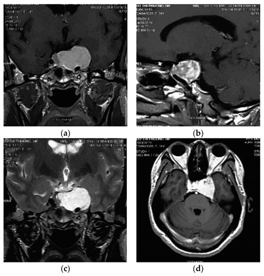 Surgical Treatment of Cavernous Sinus Cavernomas: Evidence from
