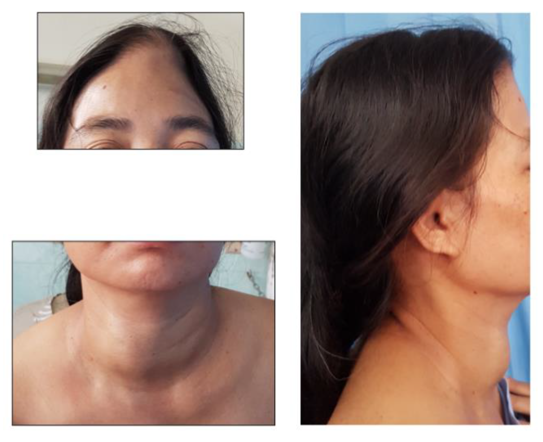 Reports | Free Full-Text | Concurrent Hip Pain and Skull Lump as the First Manifestations of a Silent Follicular Thyroid Carcinoma Reports | Free Full-Text | Concurrent Hip Pain and Skull Lump as the First Manifestations of a Silent Follicular Thyroid Carcinoma
