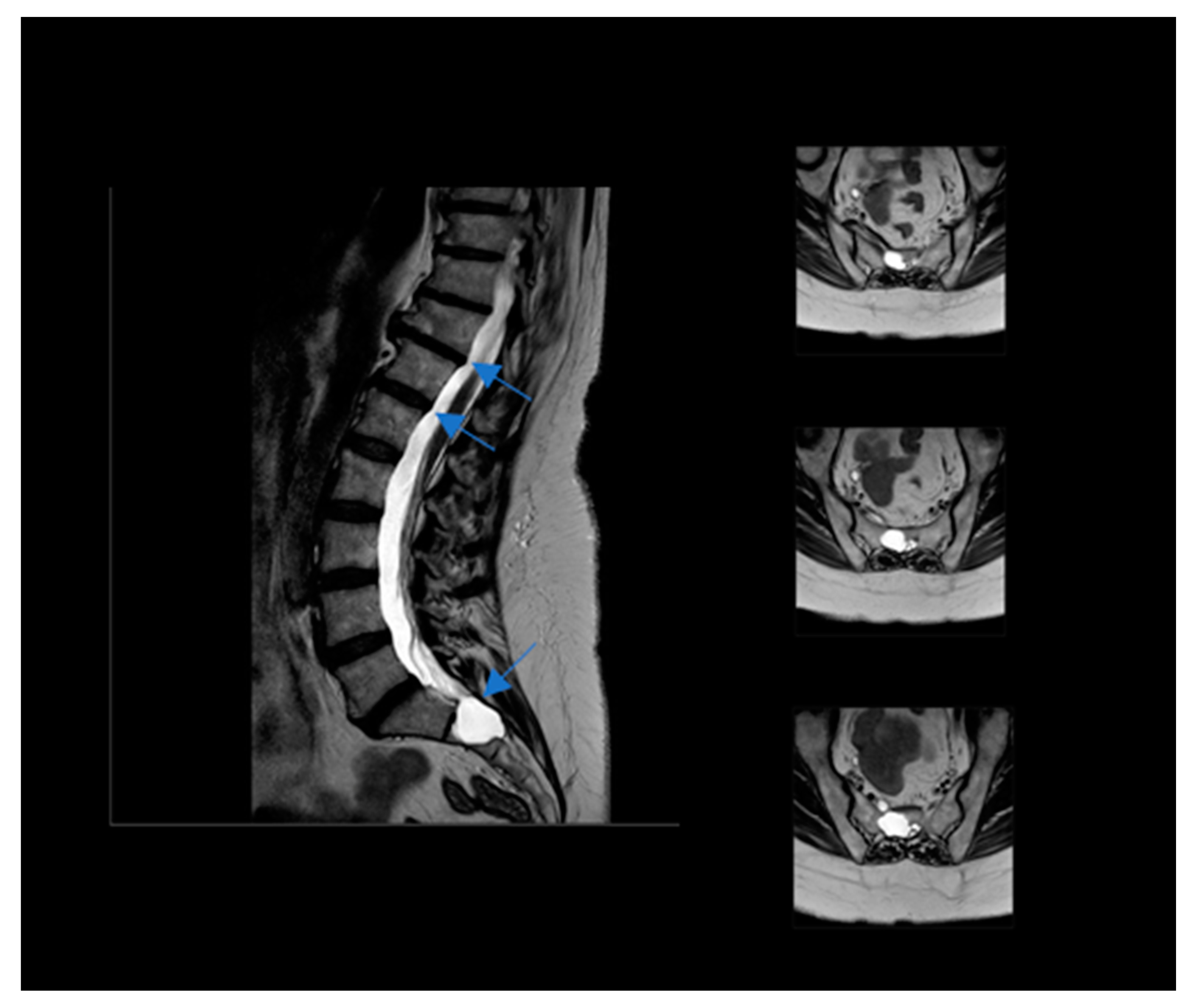 Ketogenic Diet and Physical Exercise on Managing Tarlov Cysts A Case