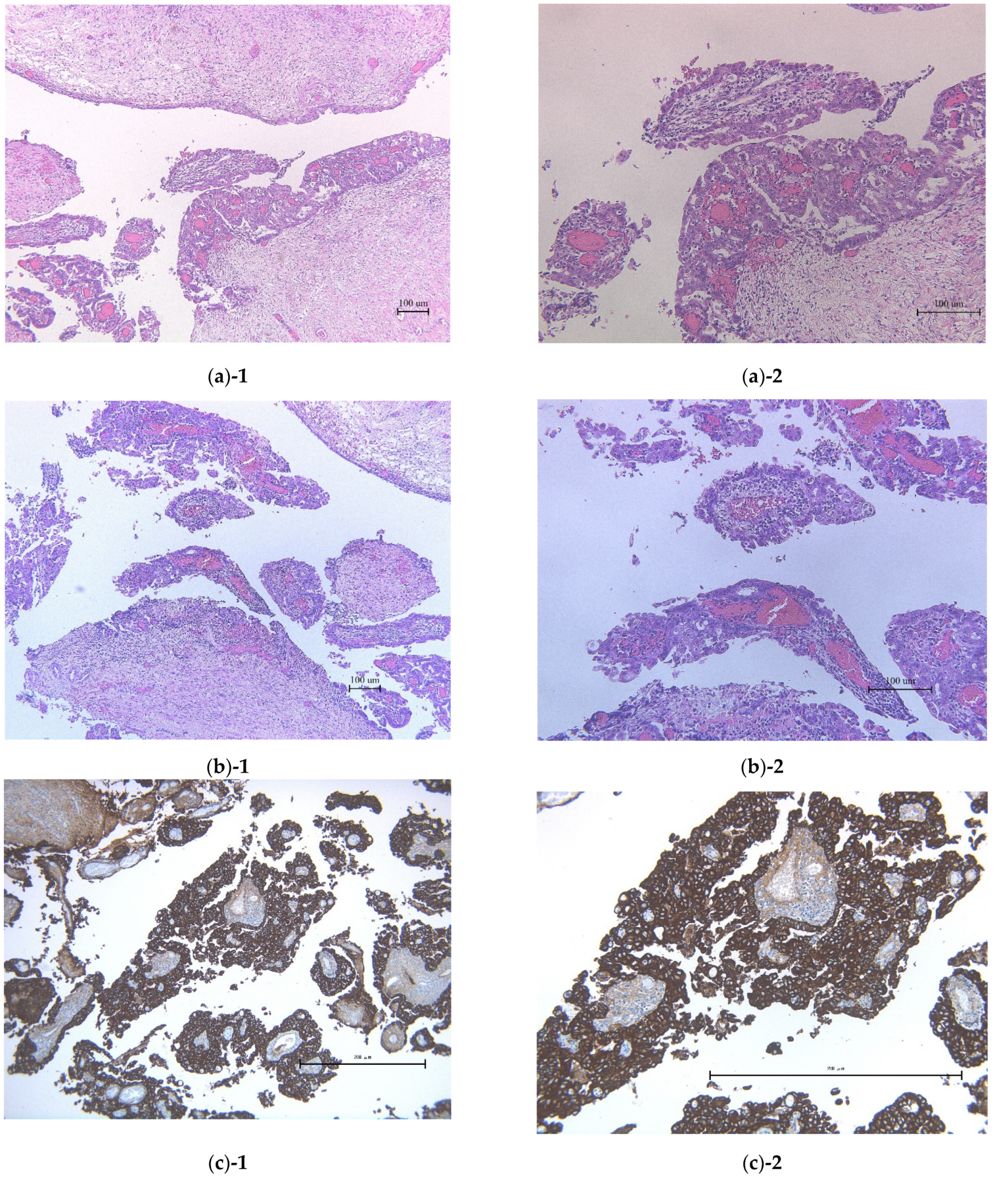 PDF) Age-dependent differences in borderline ovarian tumours (BOT