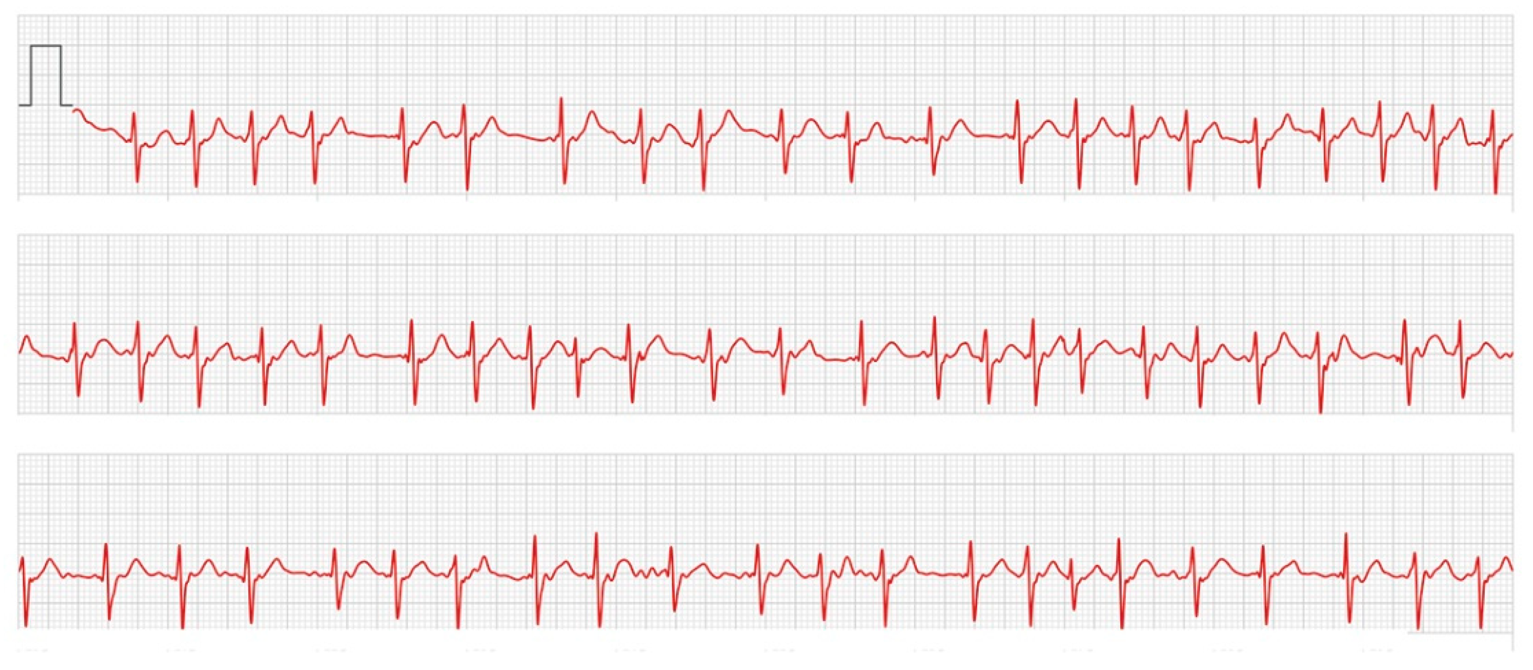 Apple Watch for Pulse Rate Assessment Detects Unidentified Paroxysmal Atrial Fibrillation