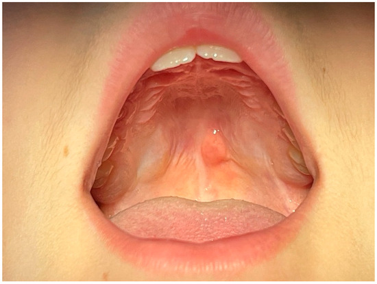 Intraoral Lipoma on the Palate of an 11-Year-Old Patient: A Case