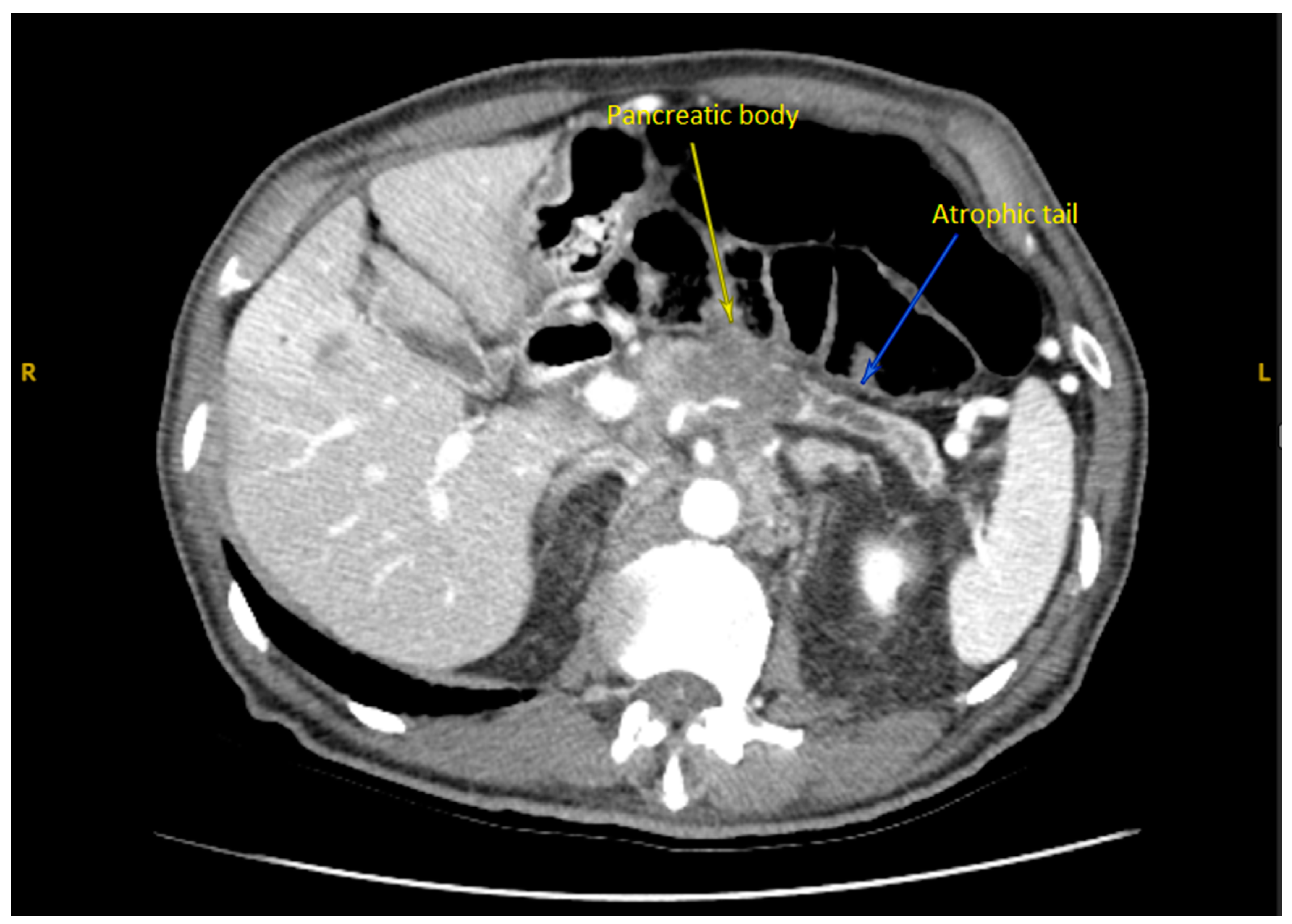 An 81-Year-Old Geriatric Patient with Metastatic Pancreatic