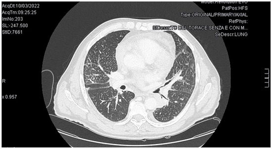 Trousseau's Syndrome and Marantic Endocarditis in a Patient with