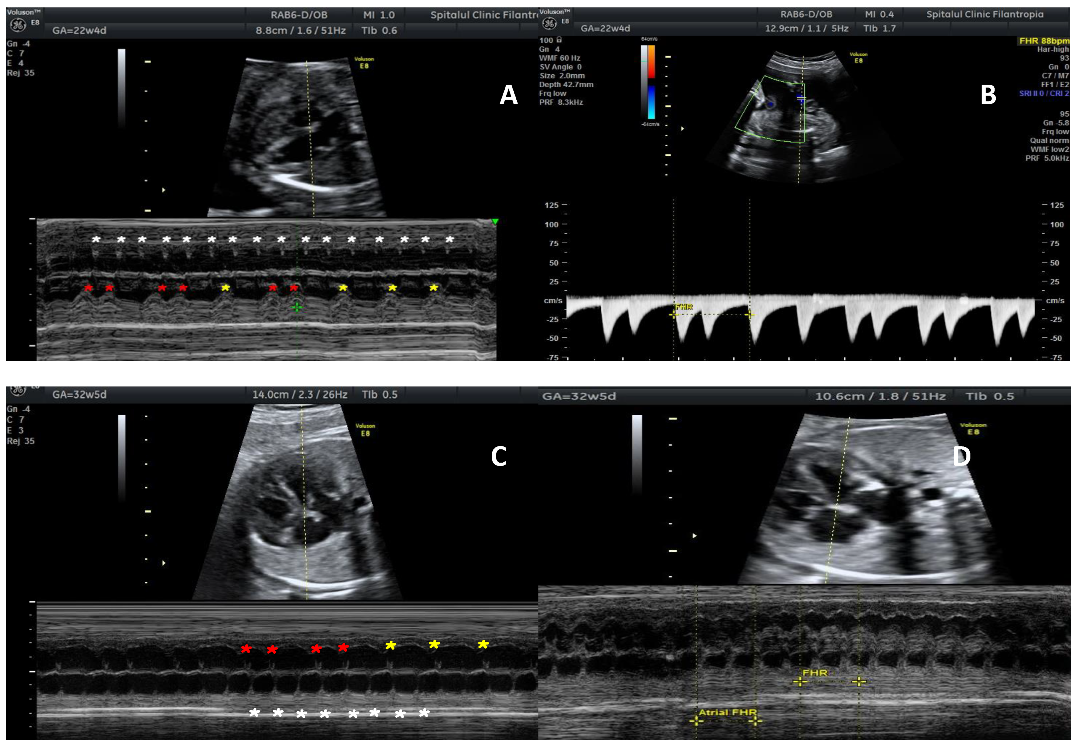 Incidence and predictors of developing high-degree AV block in patients